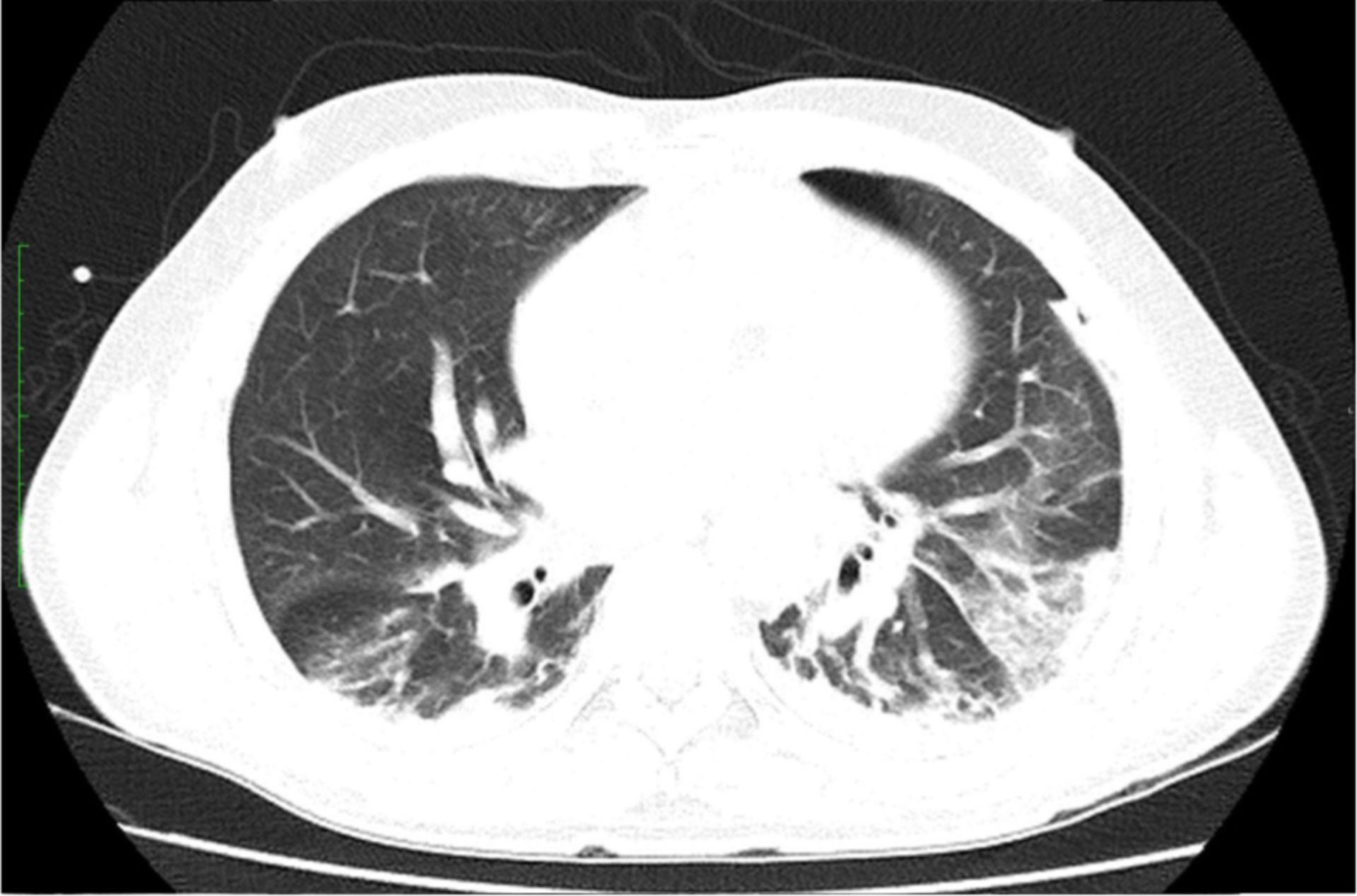 Rippenserienfraktur-Lungenkontusion