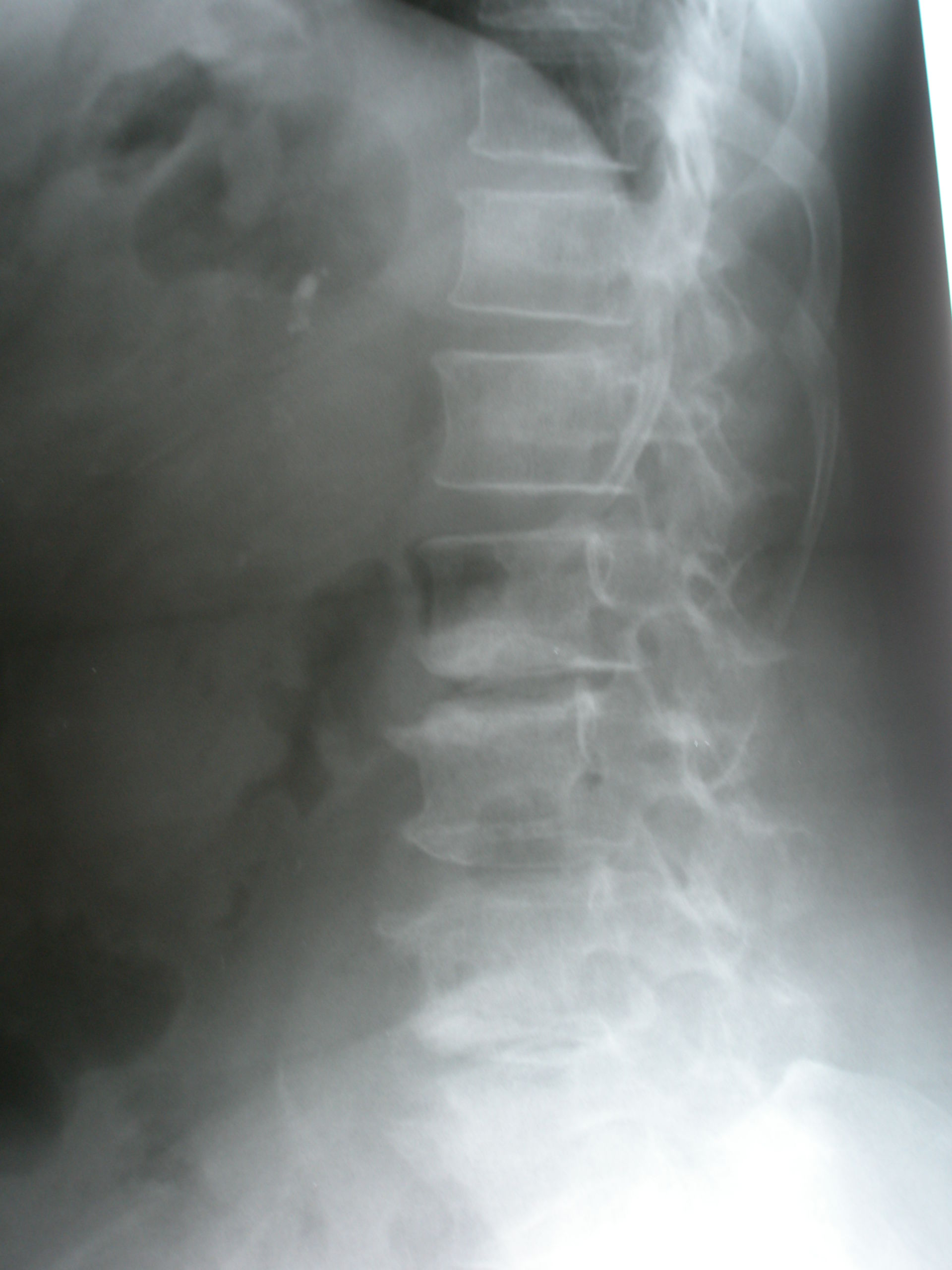 Spine Artrosi e osteofiti Mcnab
