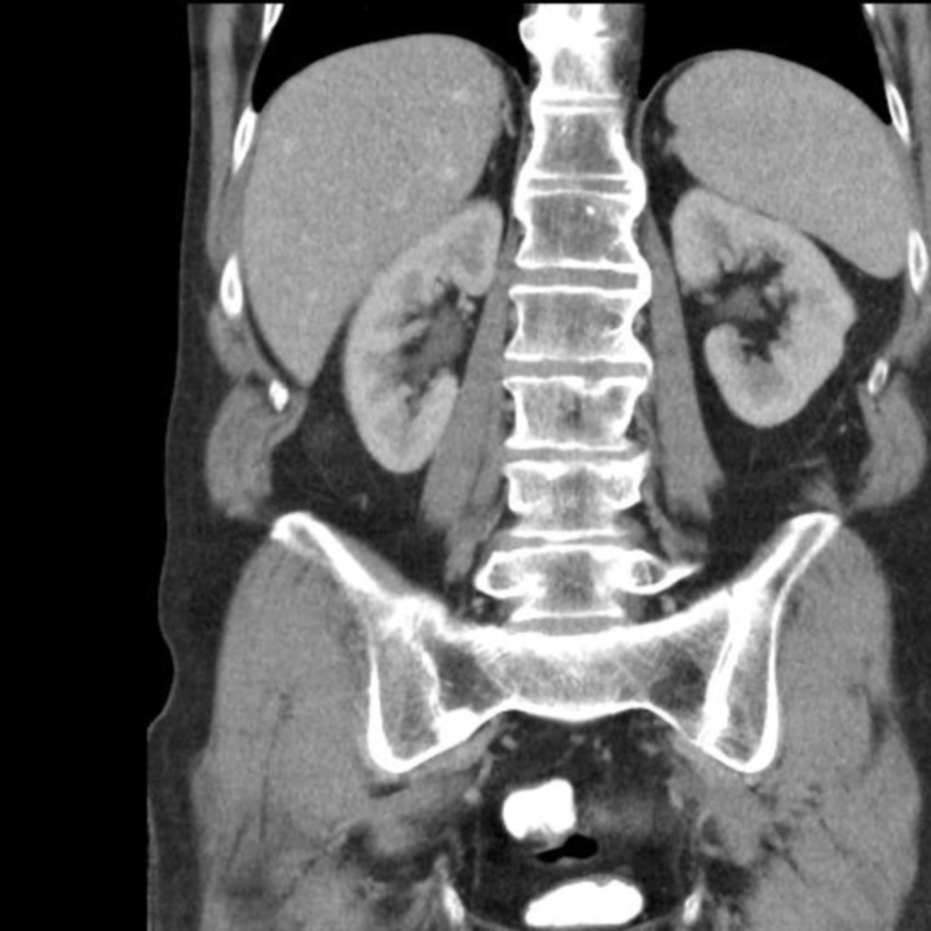 Spondylitis in a case of Crohn's disease
