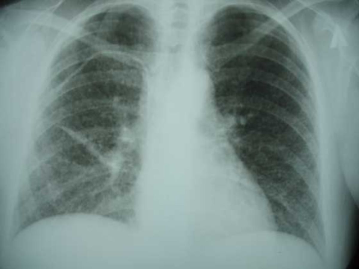 milliare Tuberkulose