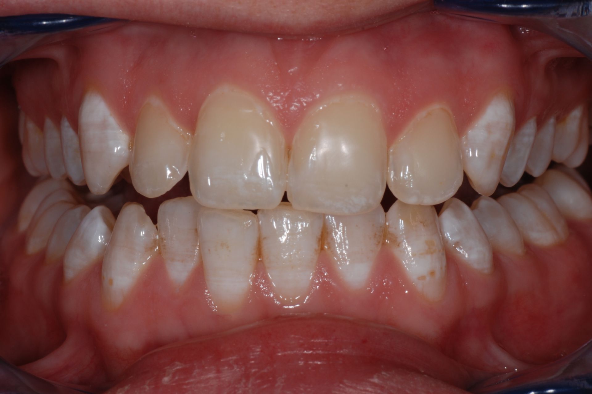 Dental fluorosis