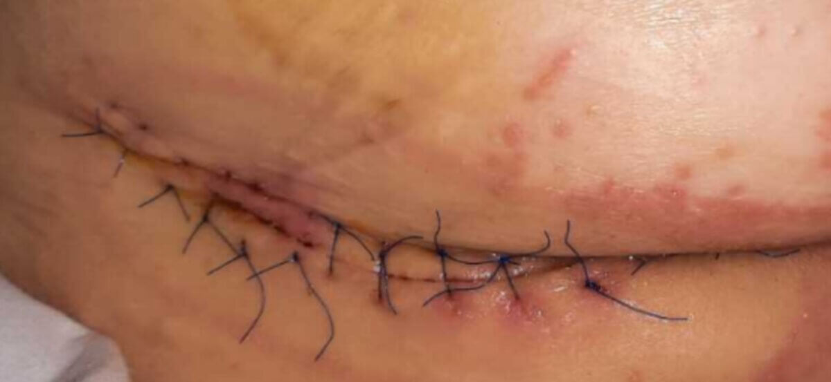 St.n Dekubitus Steissbein nach Lappenplastik