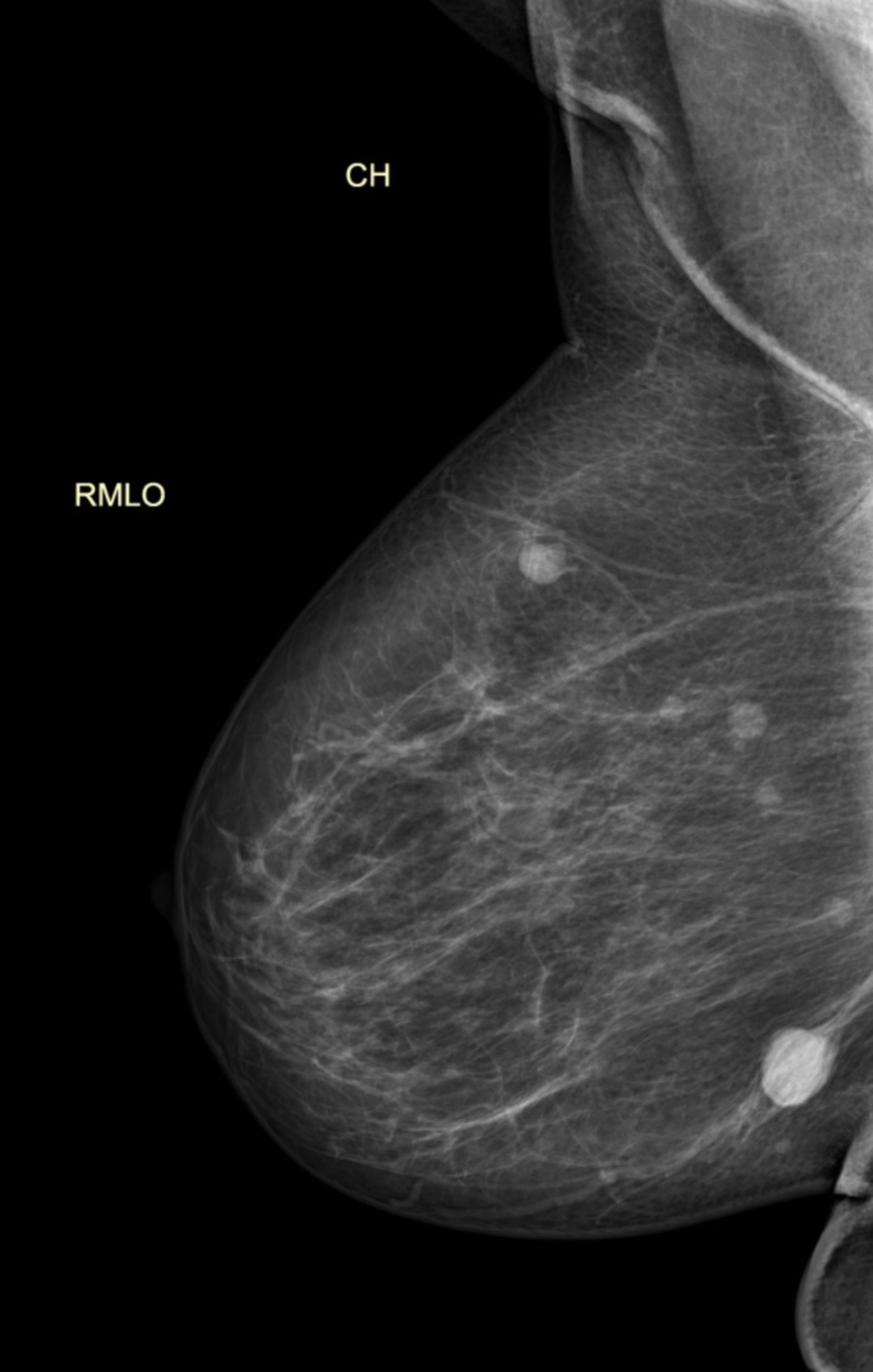 tag2_mammo_re: Mammographiebefund einer rechten Brust