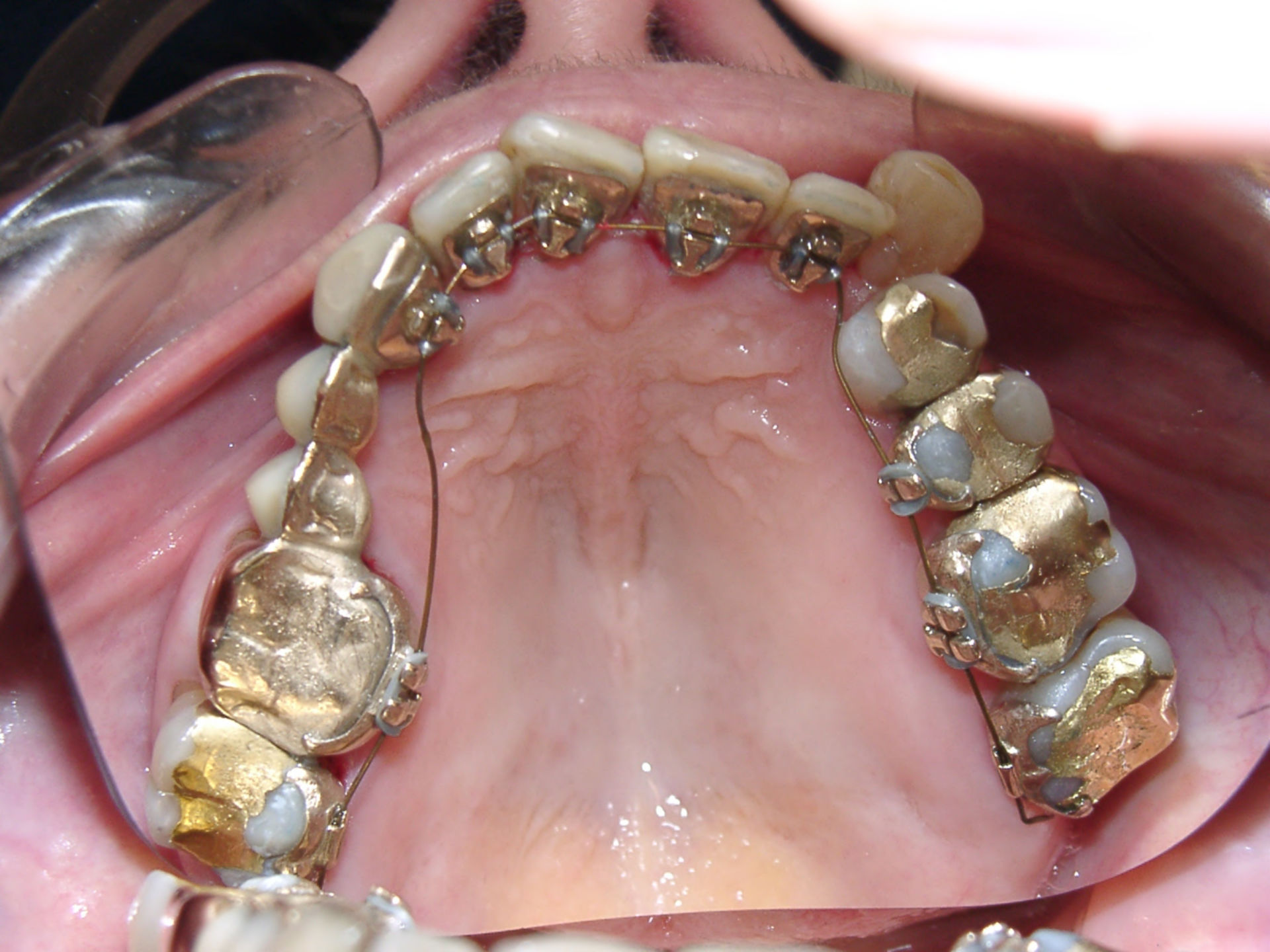71-Jährige Patientin mit lingualer Zahnspange zu Beginn KFO