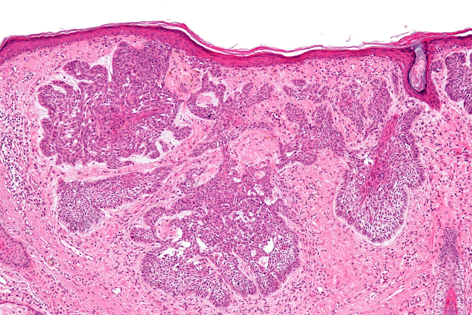 Basalioma (basal cell carcinoma, histology)