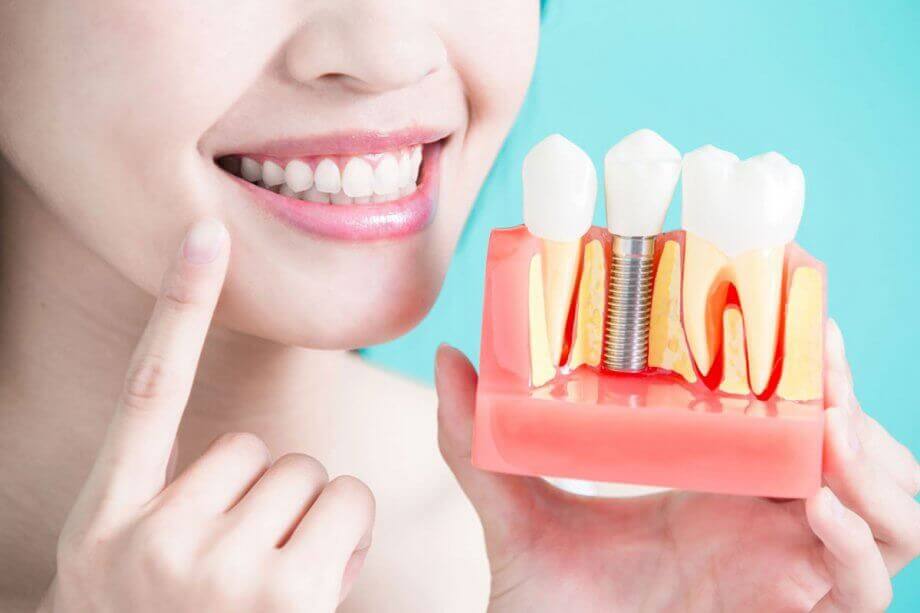 dentalimplants-800-oct2018-920x613_original.jpg