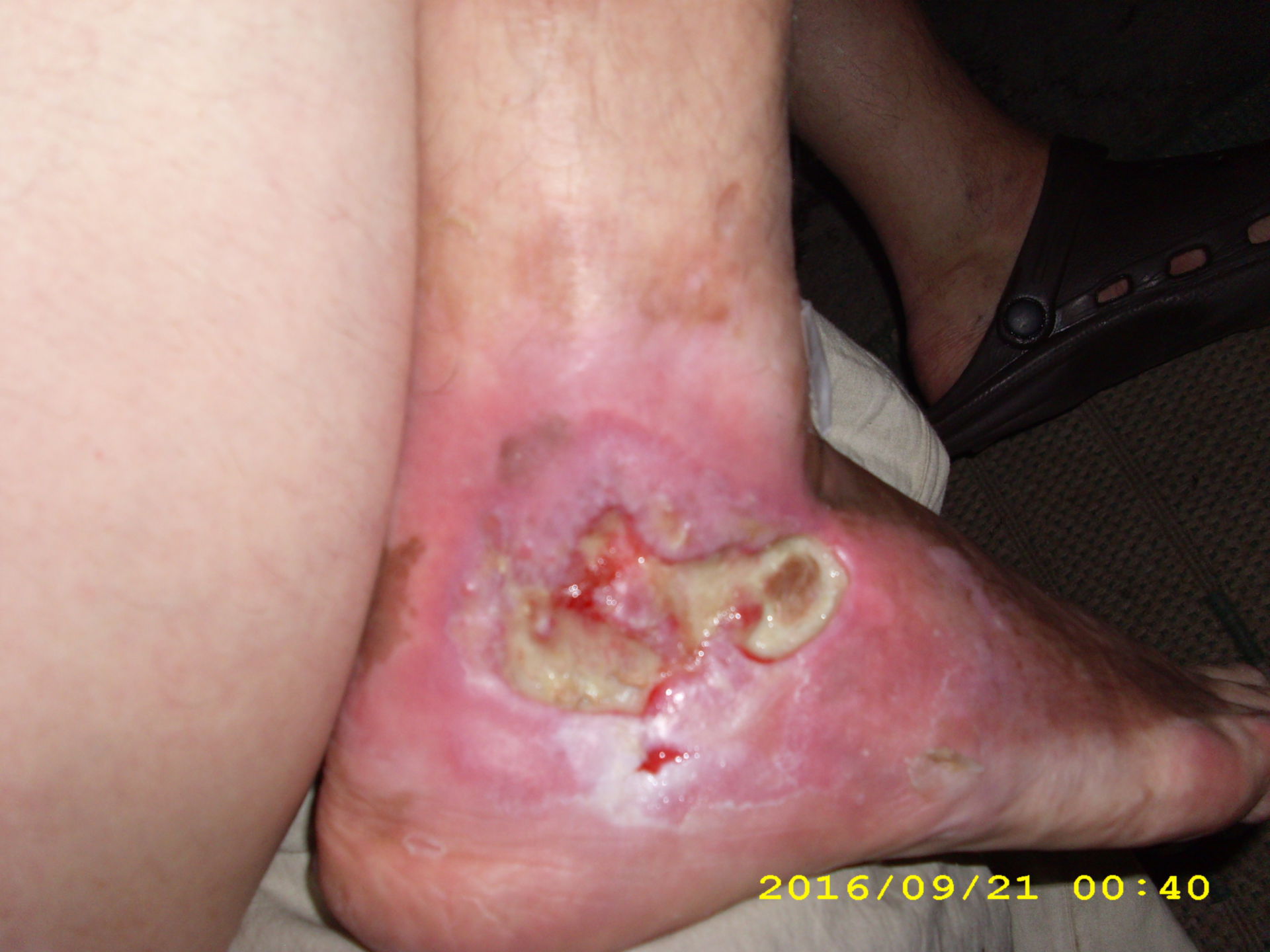 Ulcer with pseudomonas right foot lateral (09.2016)