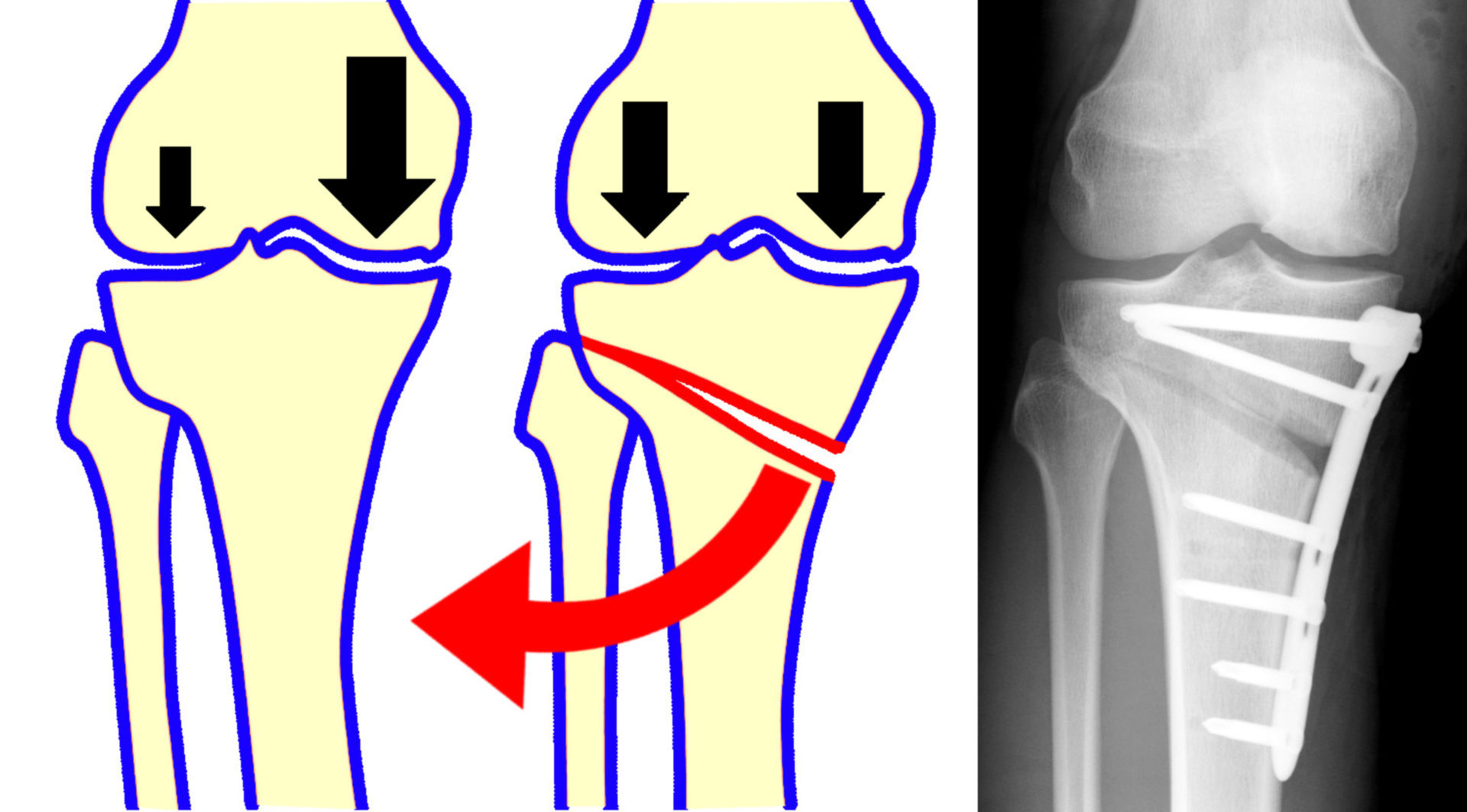 Tibiakopf-Osteotomie
