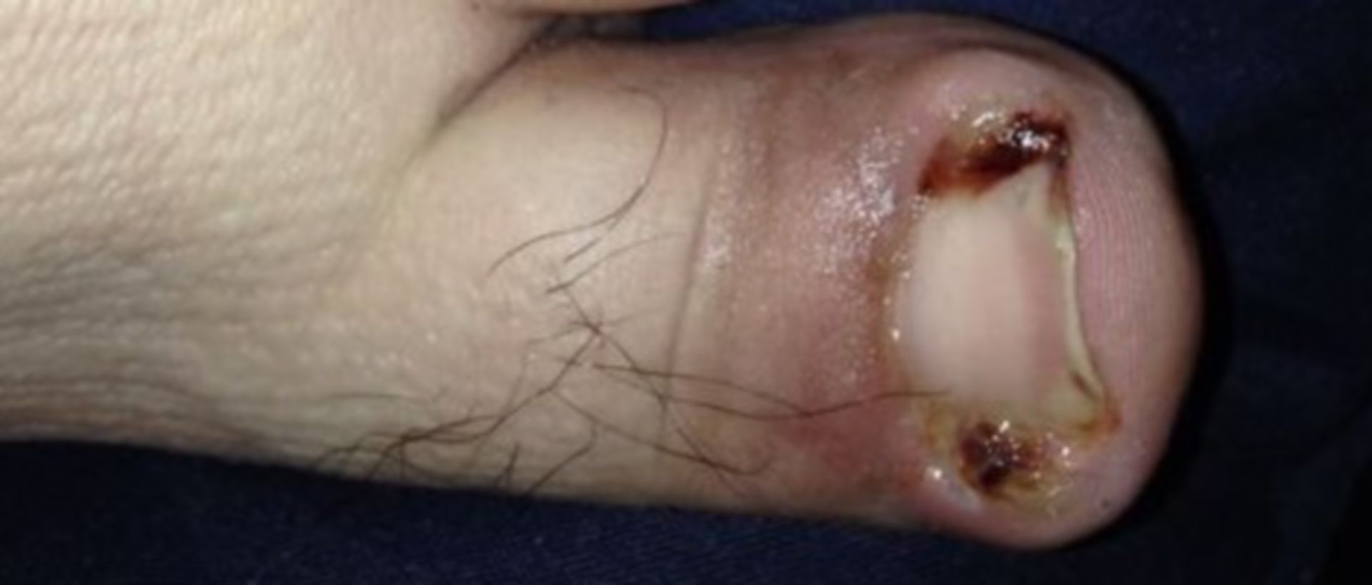 Infektion eines Zehs mit eingewachsenem Zehennagel