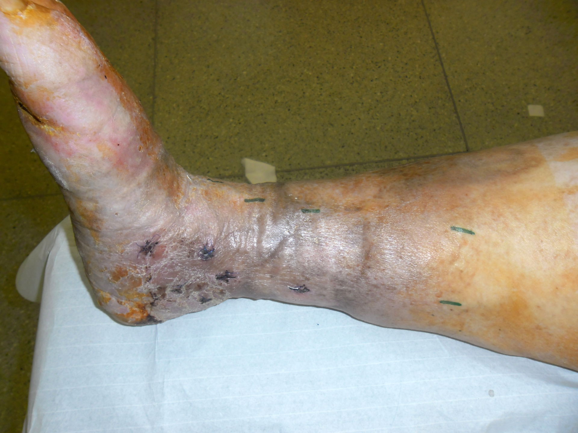 Varicosis - dermatitis congestiva