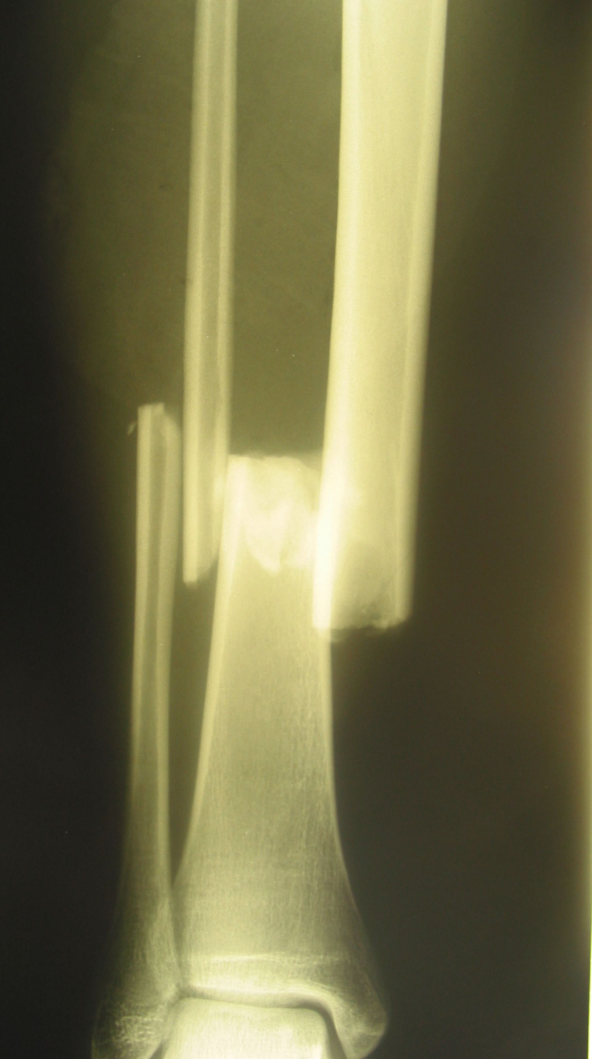 Fracture of the lower leg