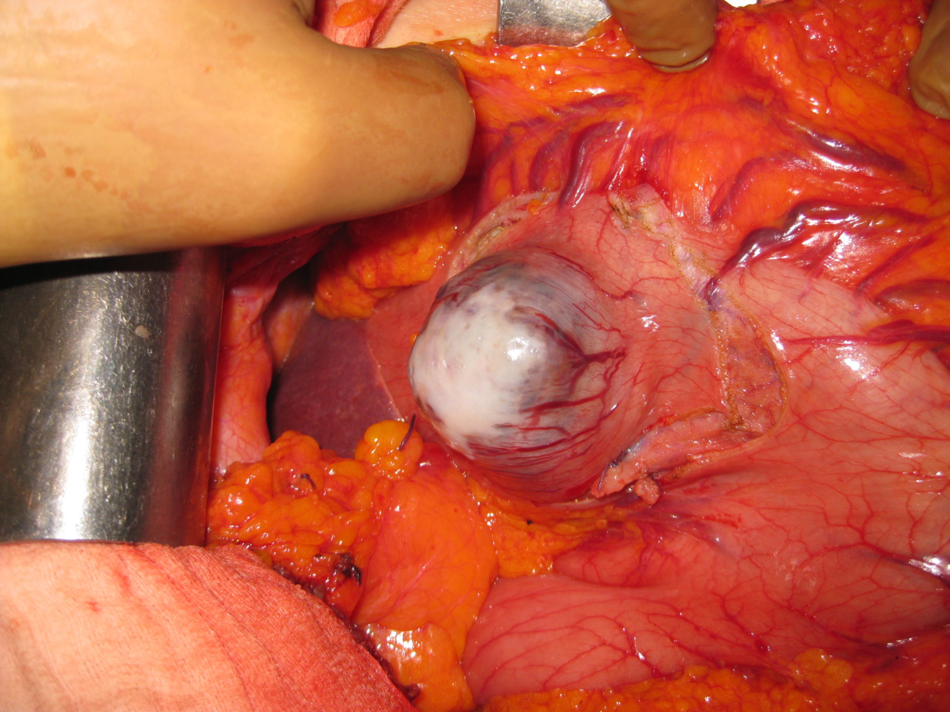 Tumor del estroma gastrointestinal en un paciente de 80 años