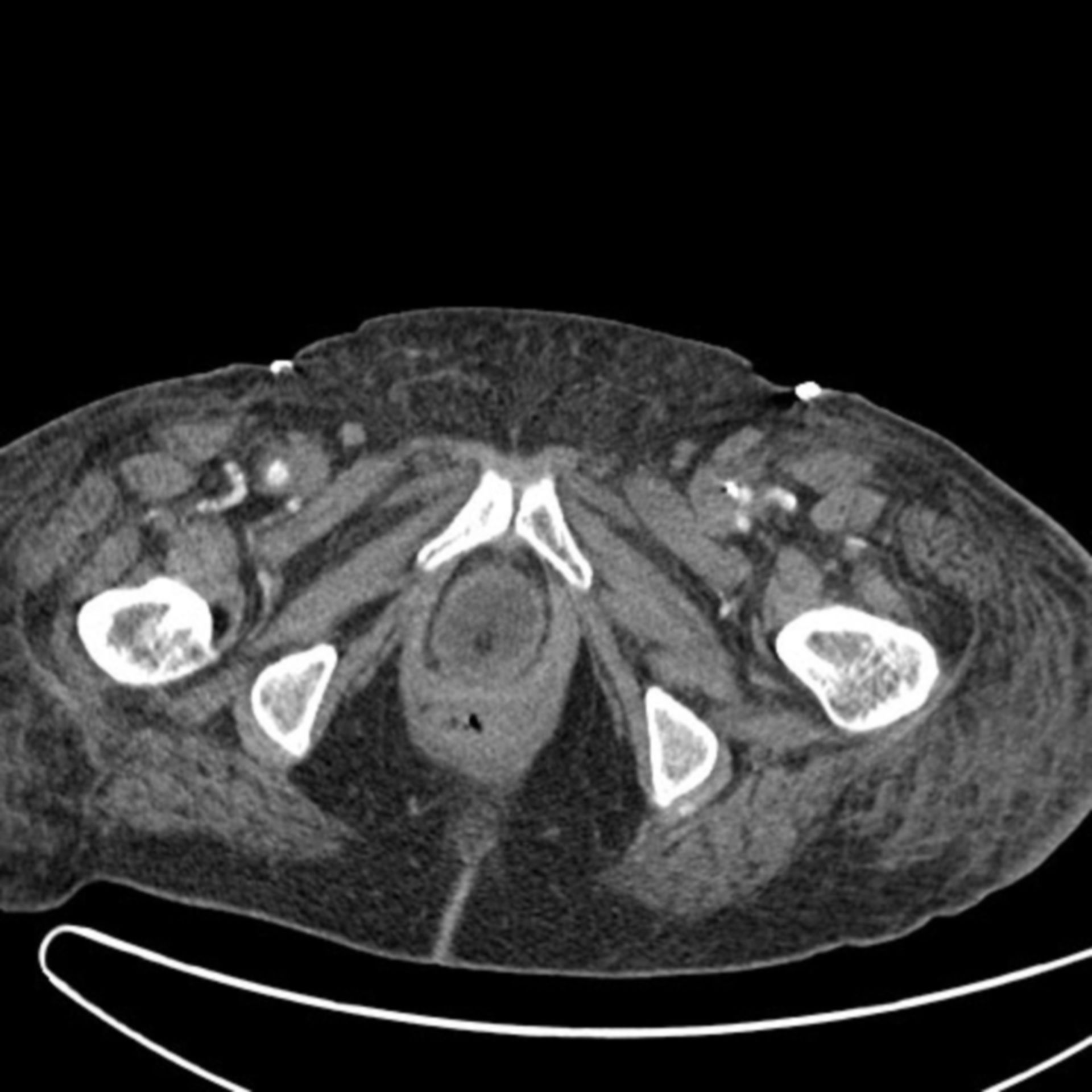 MRT Thorax