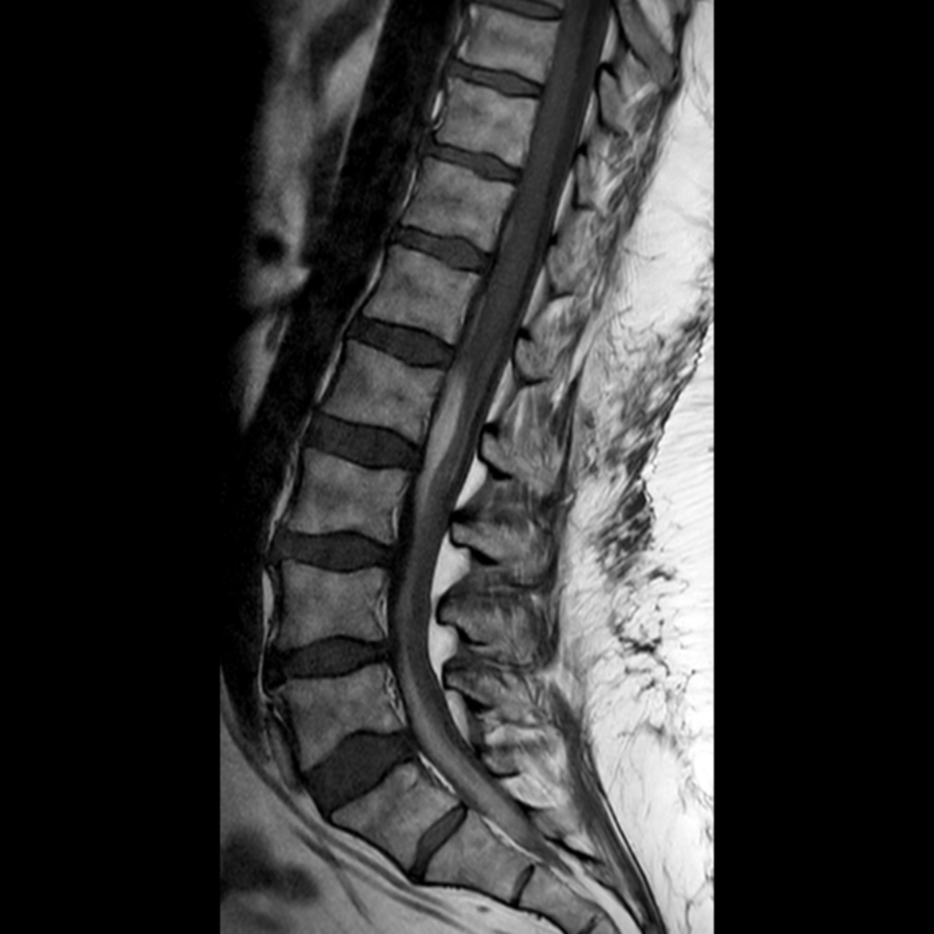 MRT spine