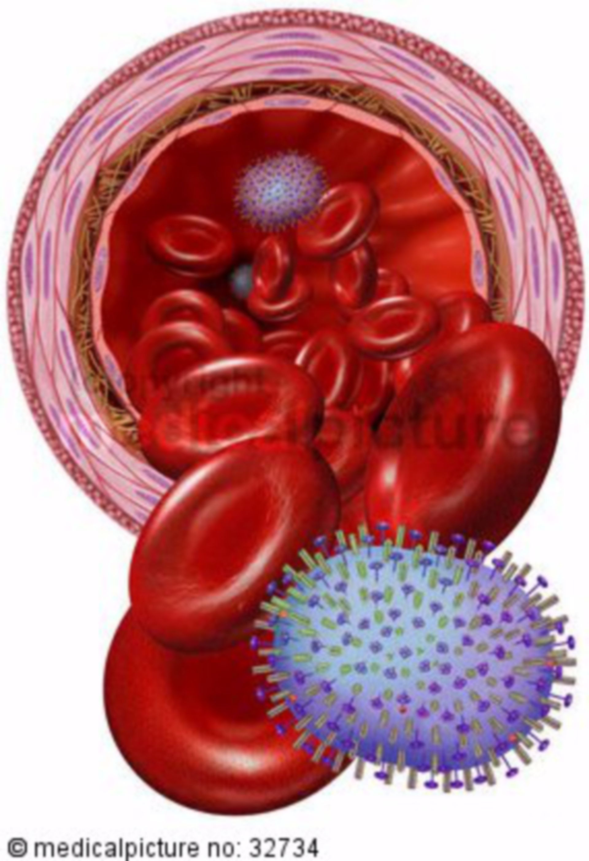  H5N1 Virus mit Blutzellen, Influenza-A with blood cells, avian influenza 
