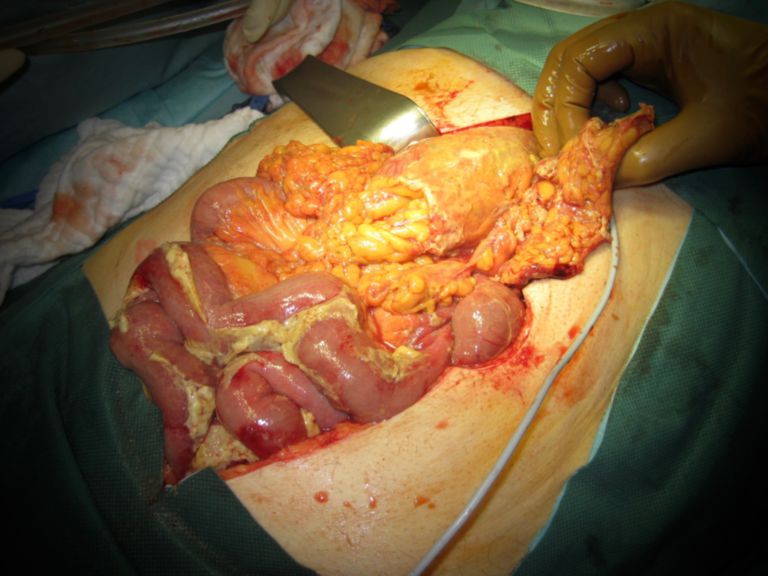 Diffuse Peritonitis - DocCheck