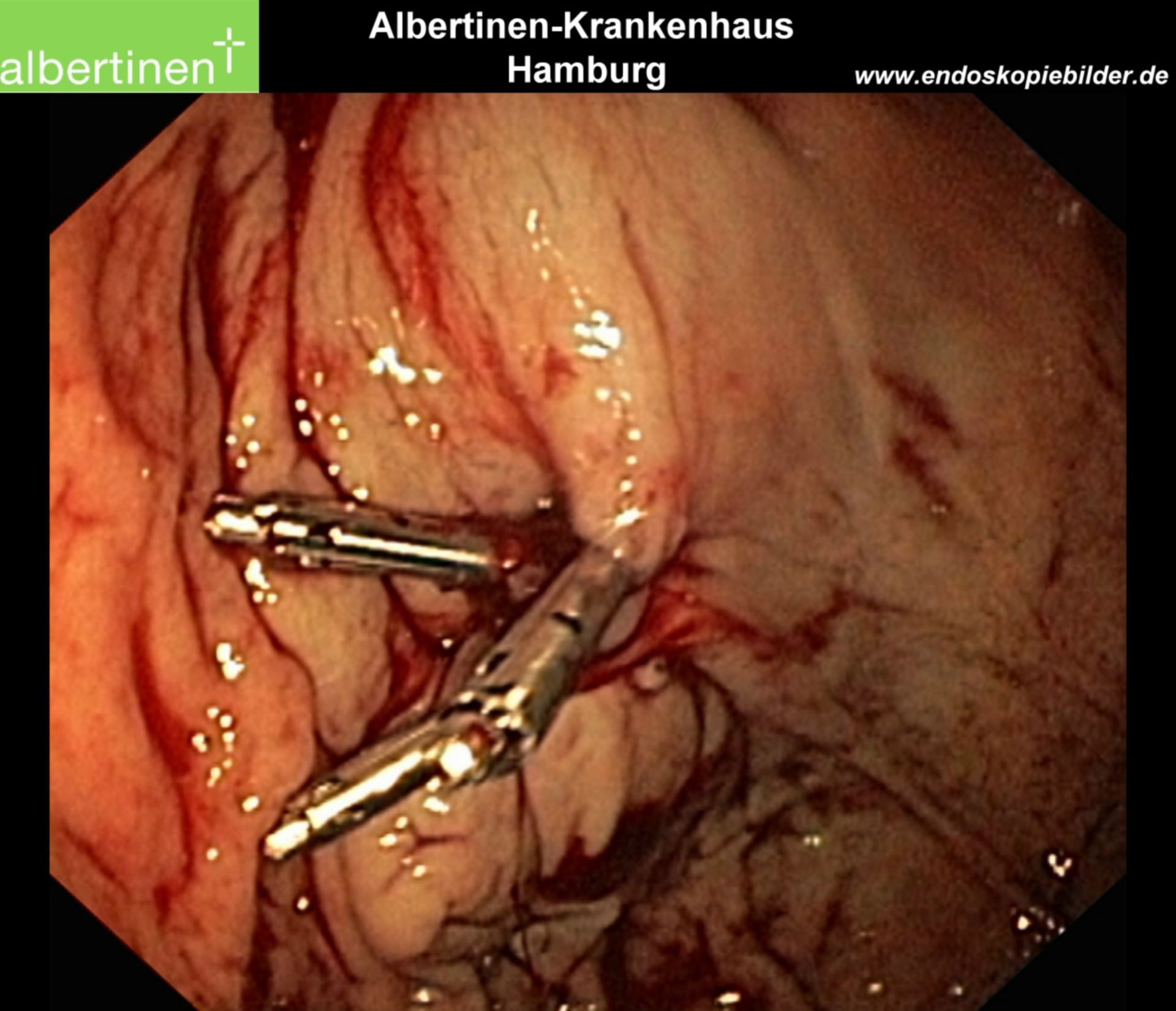 Forrest 2a Fundus-Blutung Clip Endo