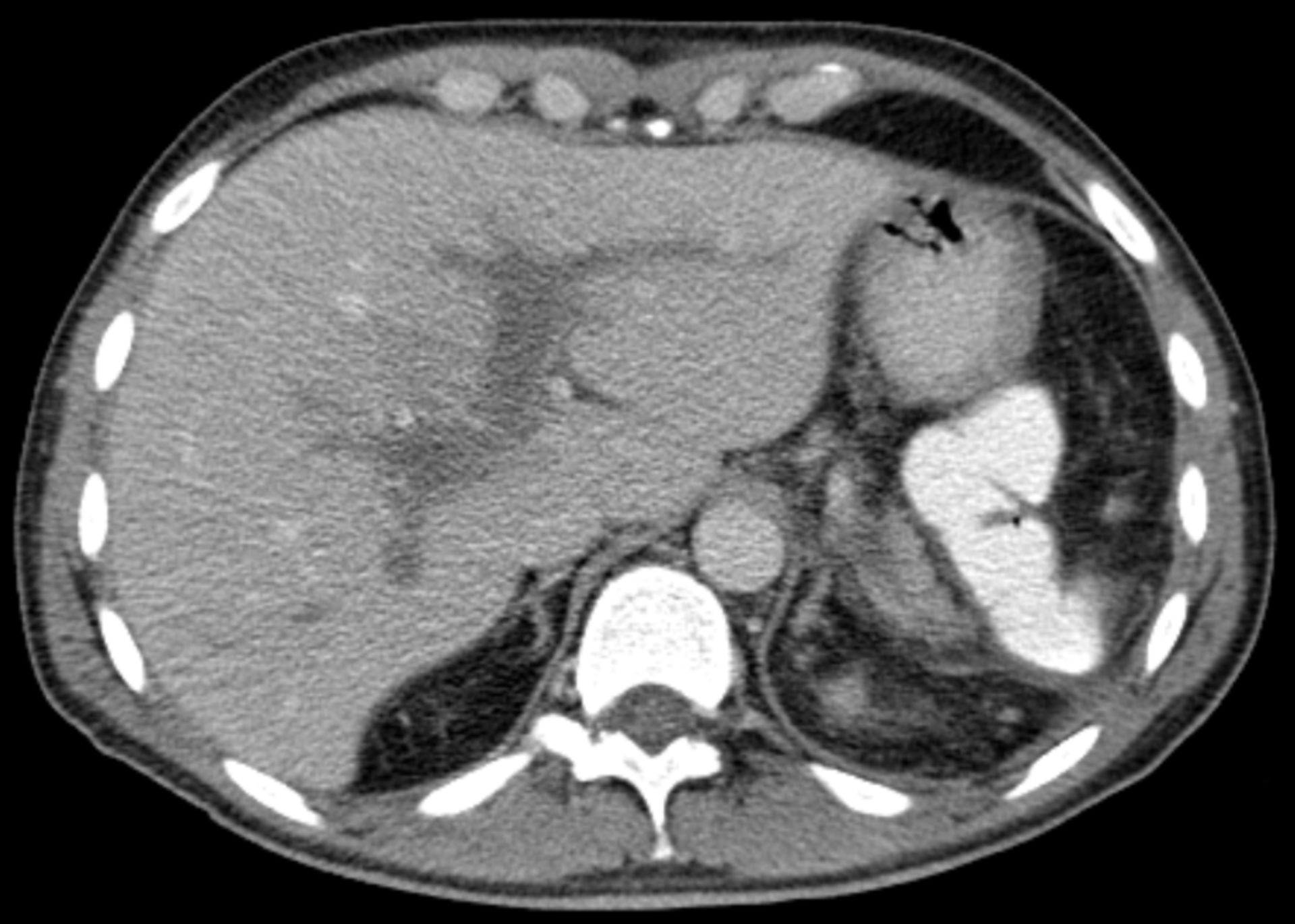Pfortaderthrombose (CT)