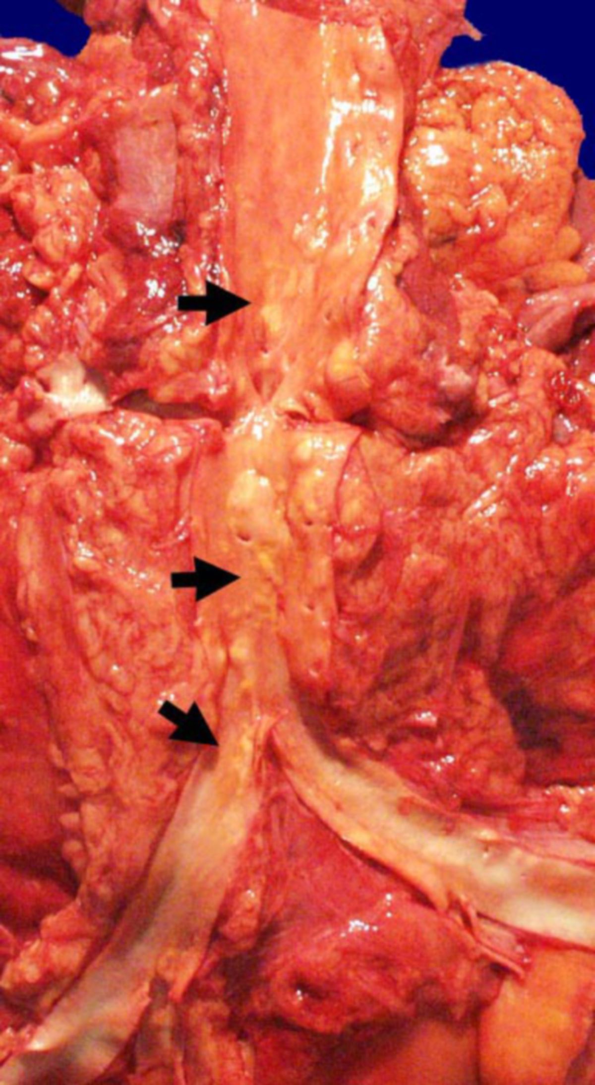 Aorta abdominalis (Leichte Atherosklerose)