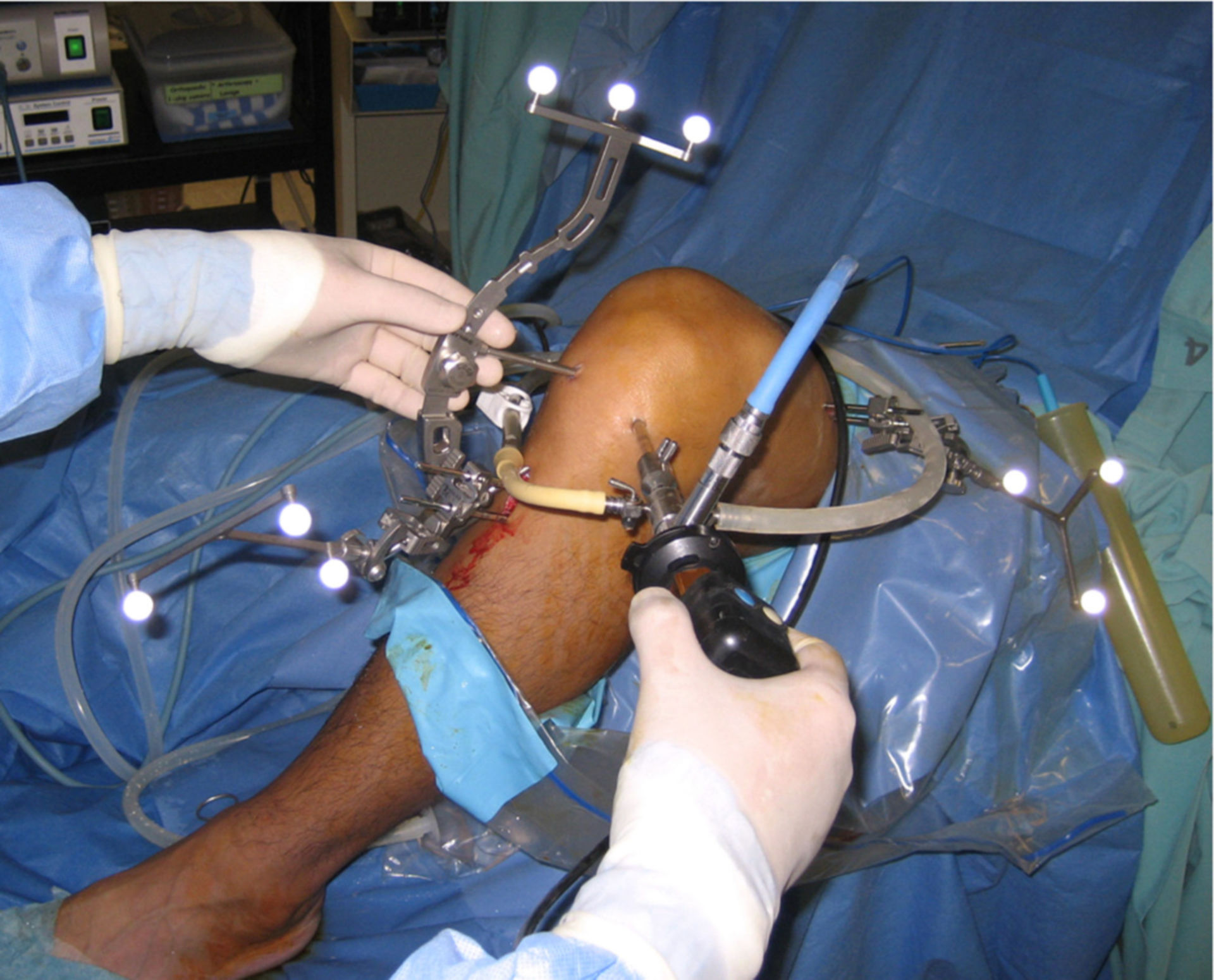 Arthroscopy with Reconstruction of the Anterior Cruciate Ligament