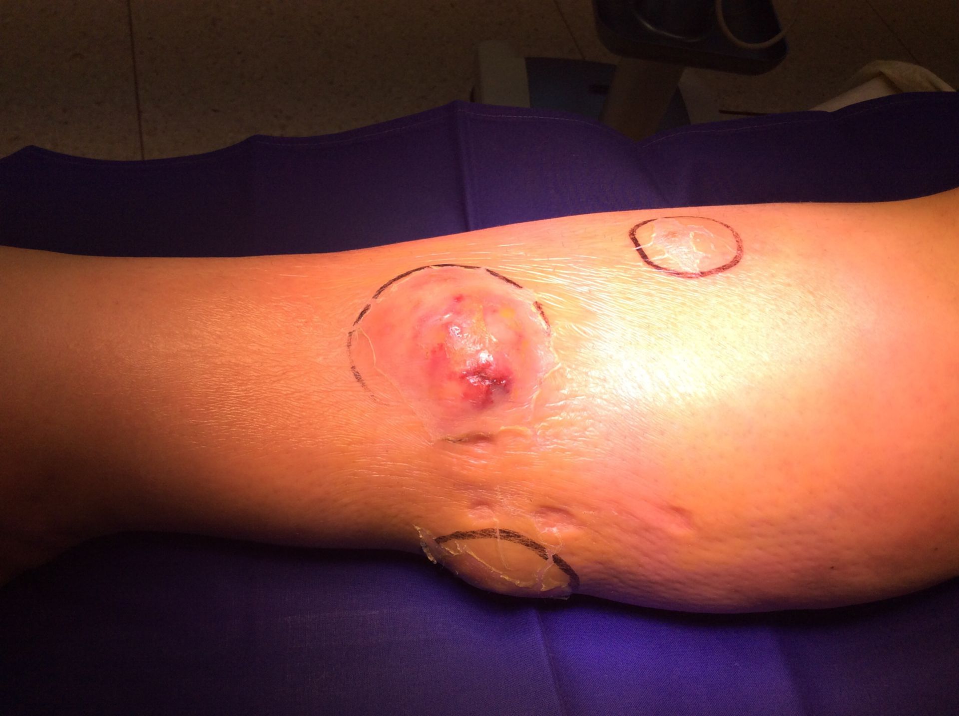 Multiple lower leg abscesses after heroin parainjection