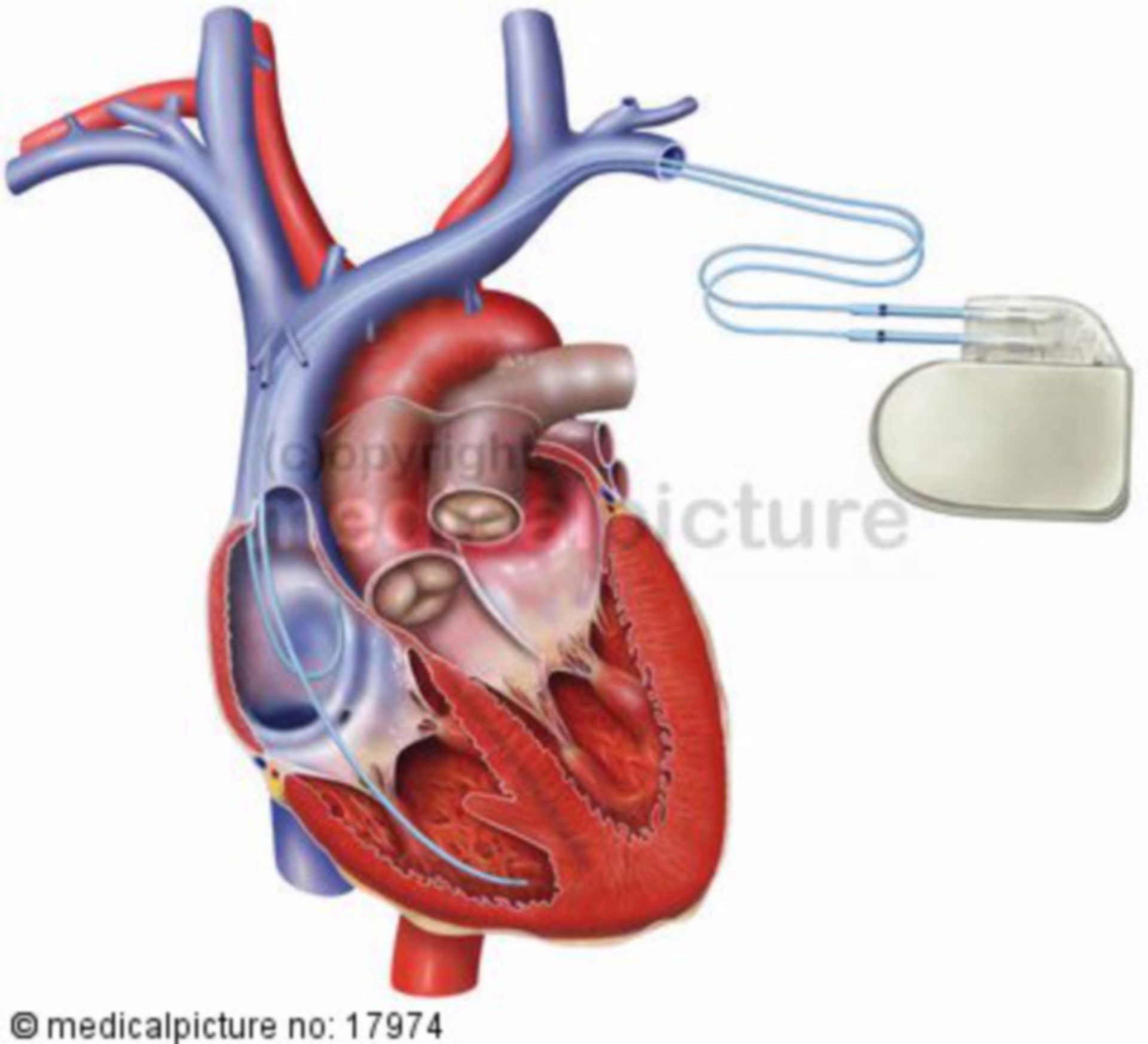 Heart with pacemaker