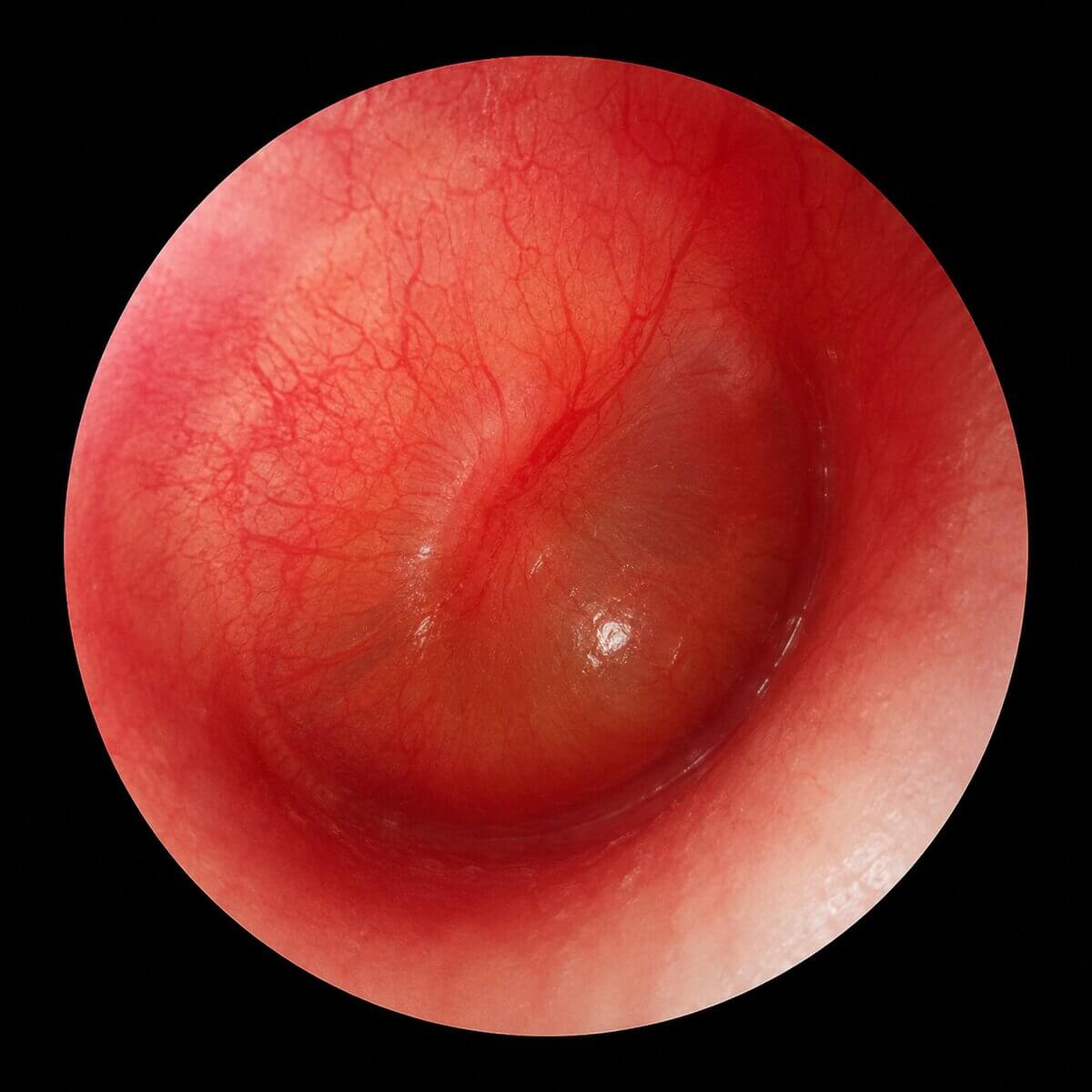 Otitis media acuta