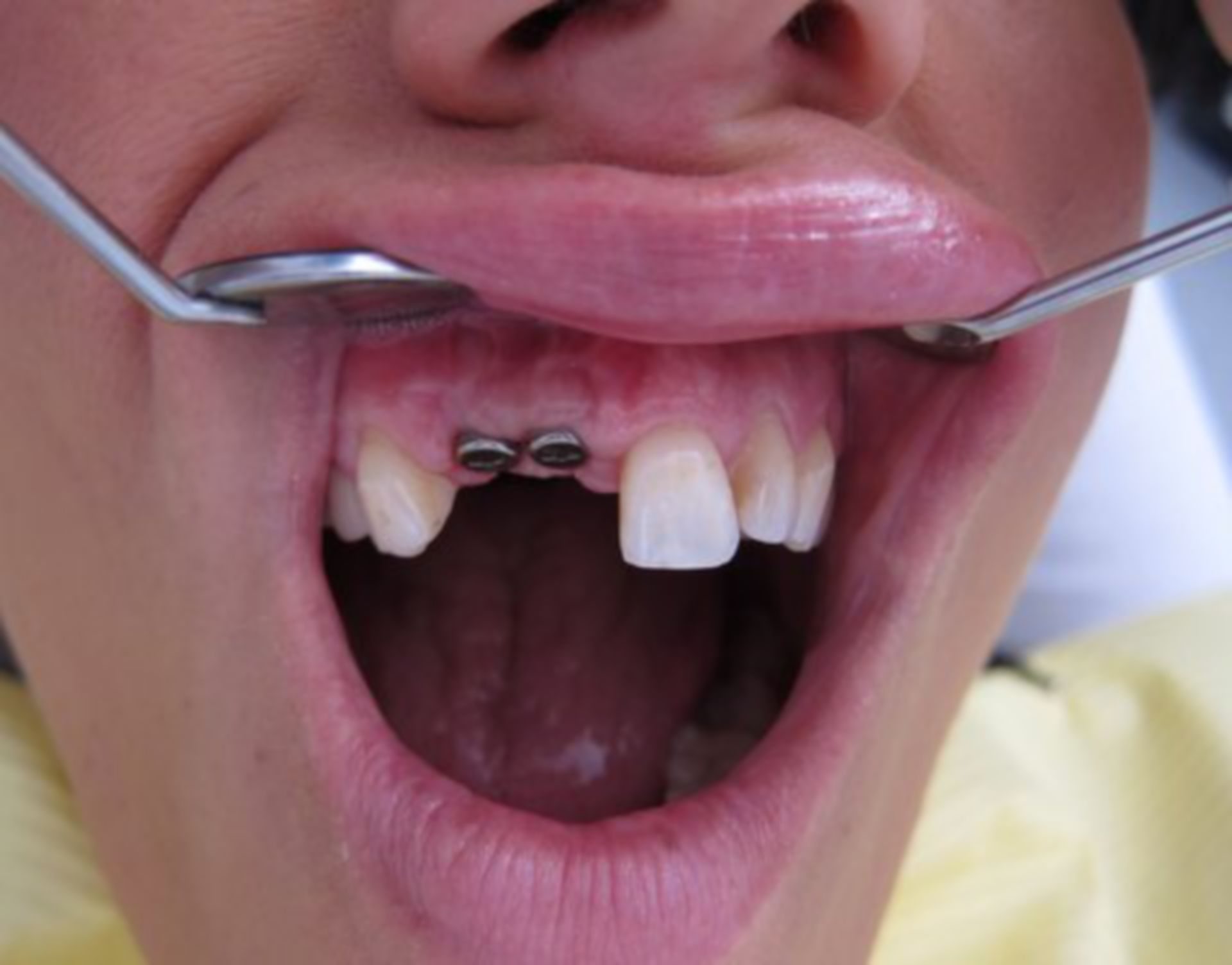 Trauma dentale con perdita di denti dopo un incidente