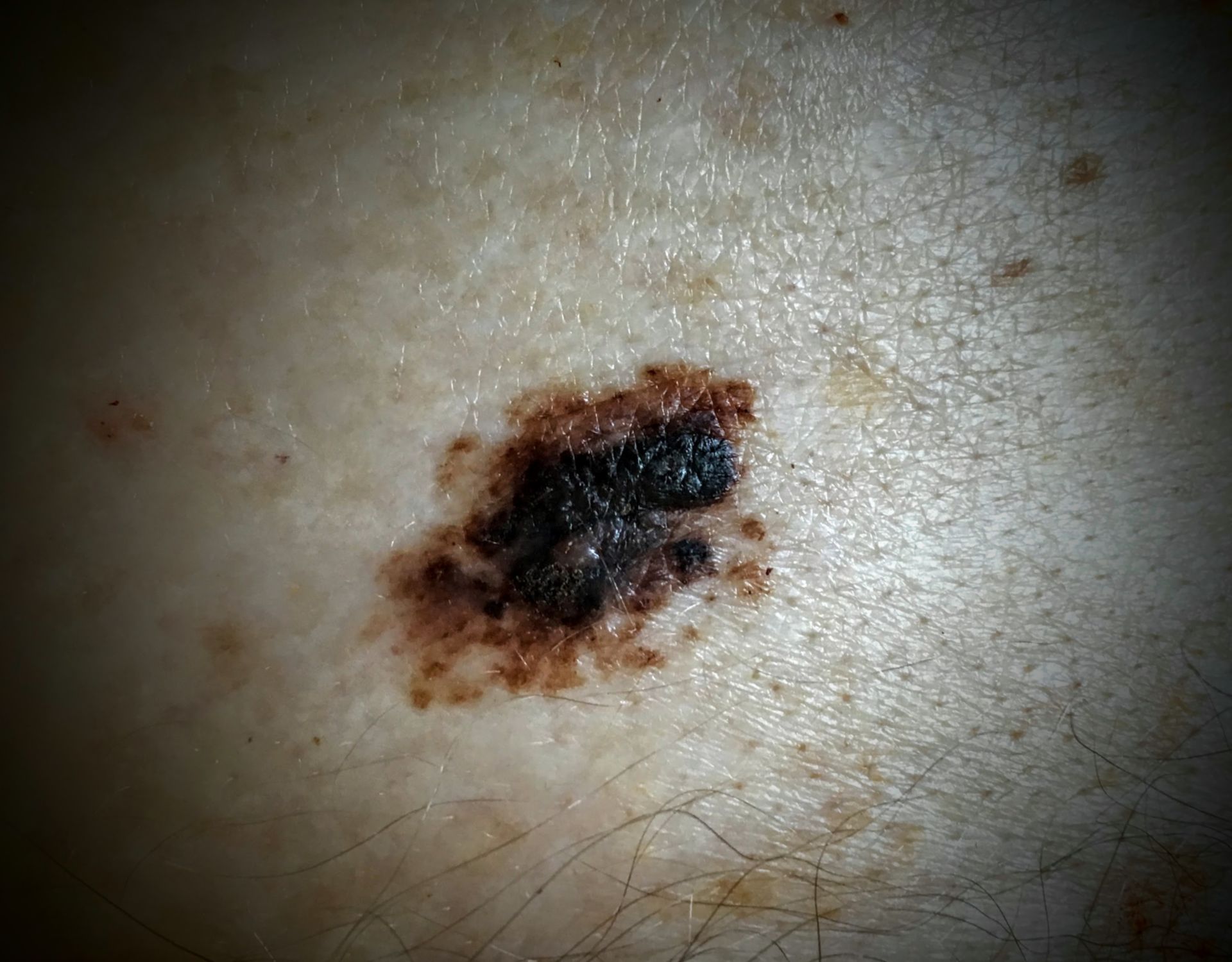 Malign melanoma