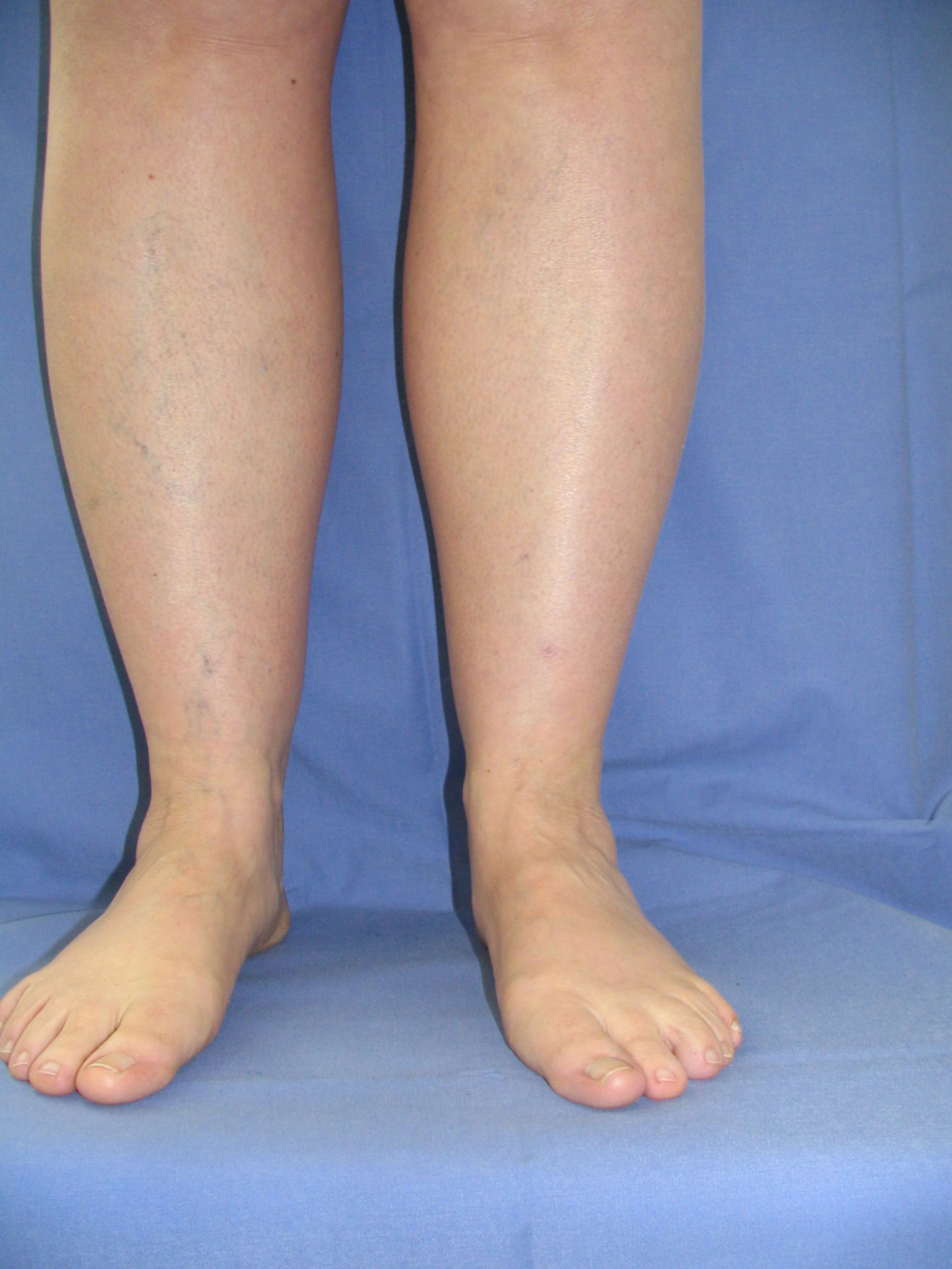 Lipoedema