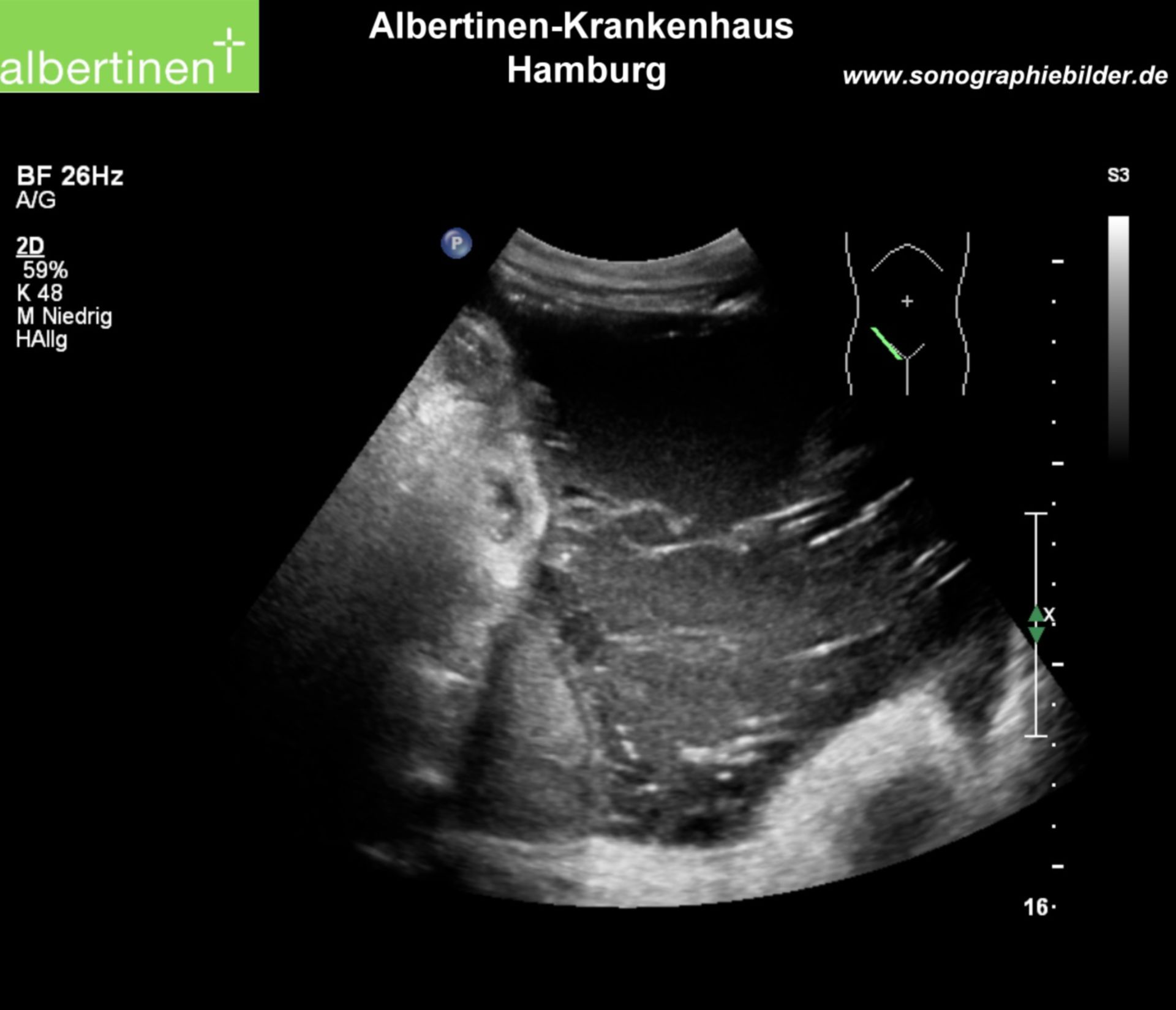 Infizierter Ascites