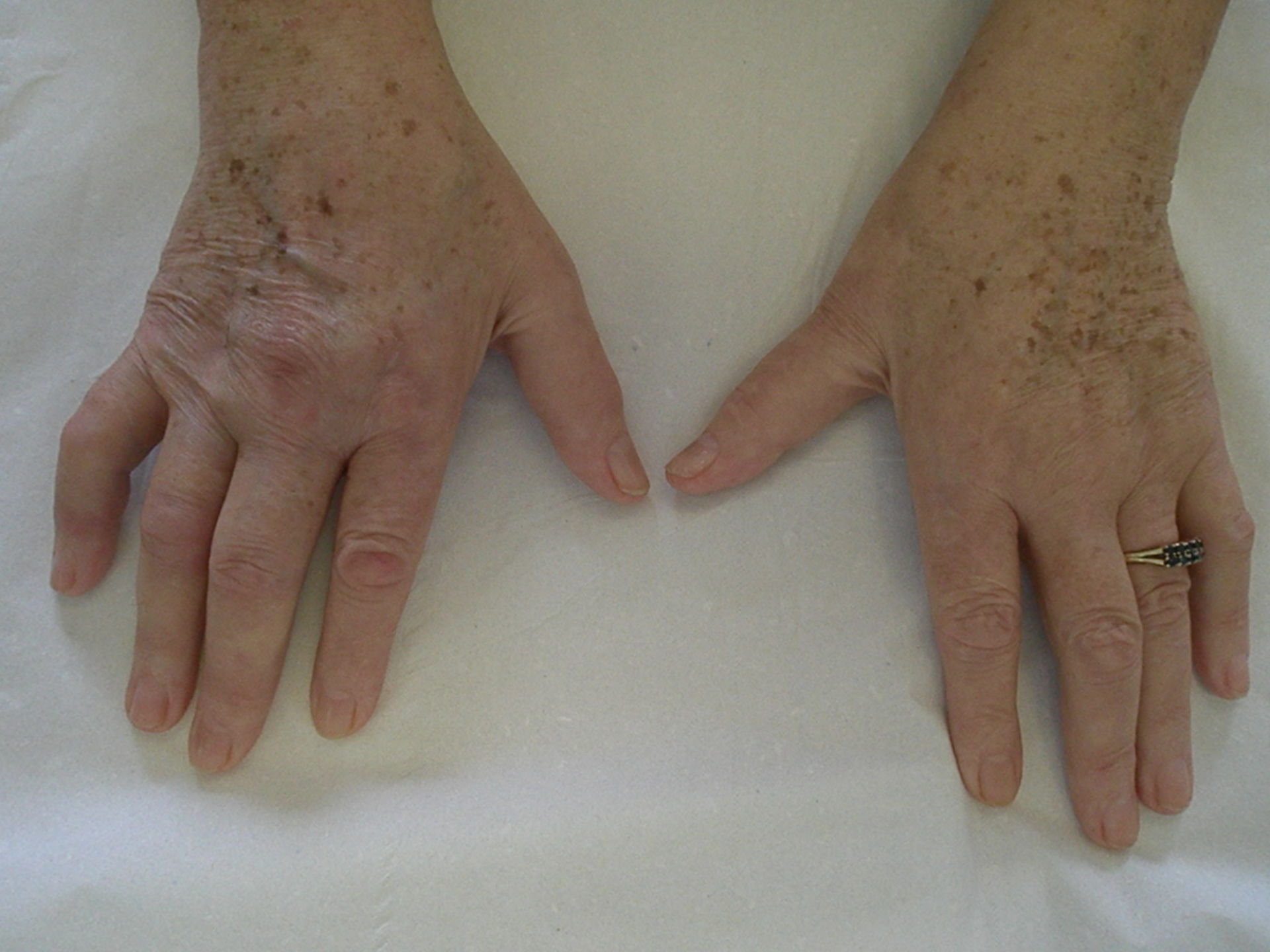 Daktylitis bei einer Patientin mit Psoriasis-Arthritis
