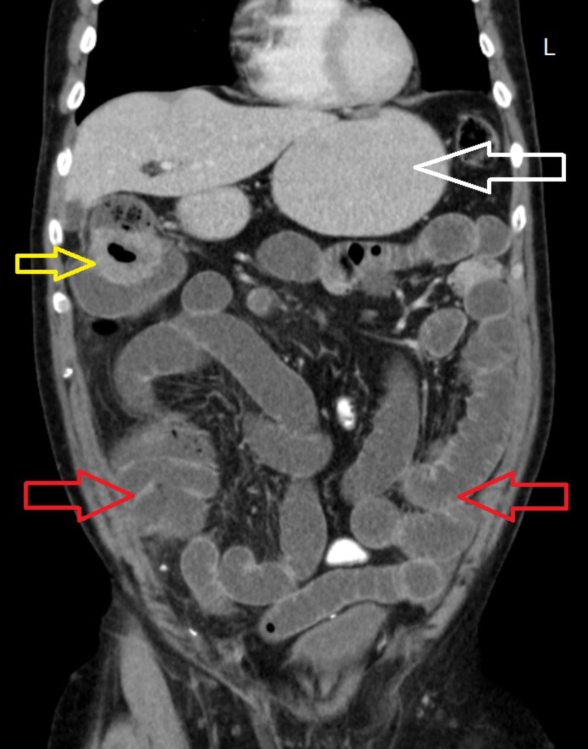 cor7: CT des Abdomens in frontaler Ebene