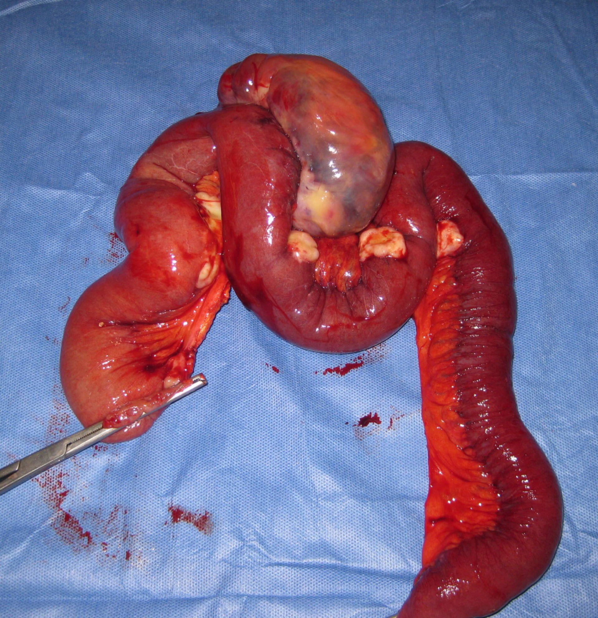 Leiomyosarcoma of small intestine