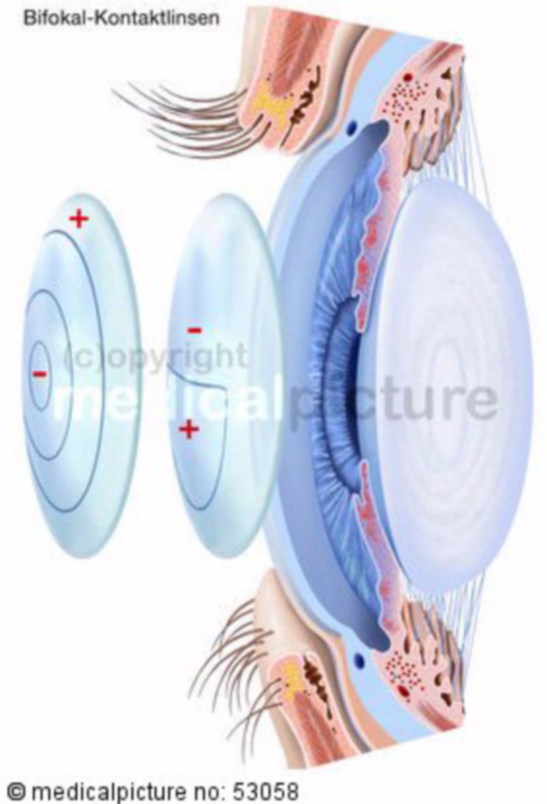  Bifokale Kontaktlinsen 
