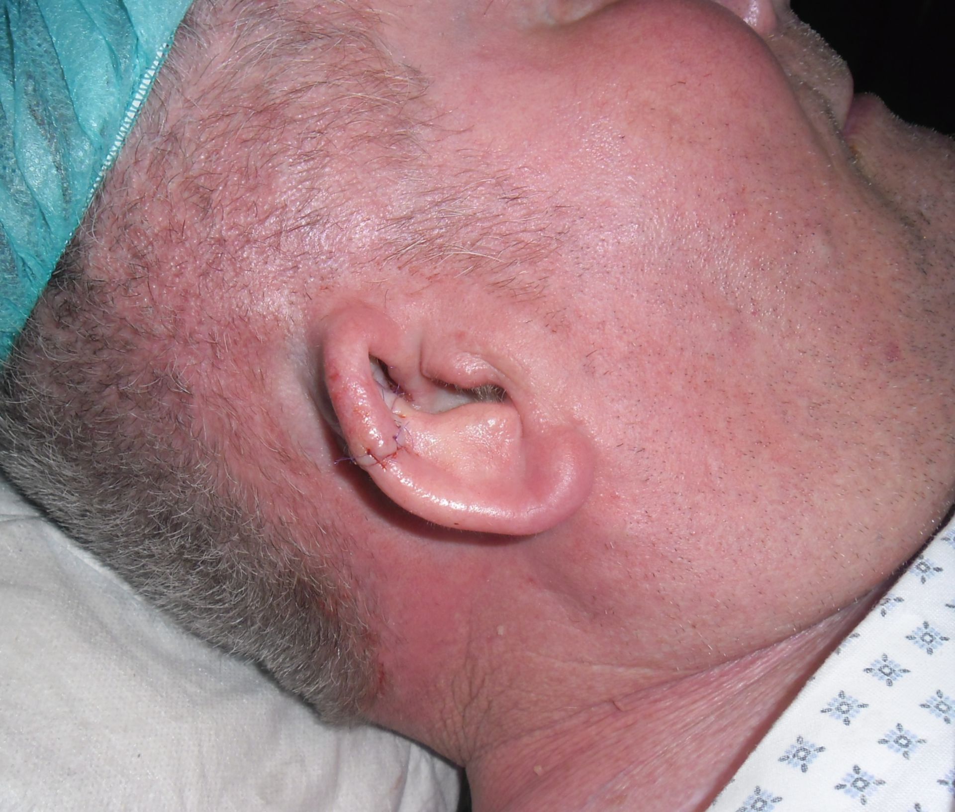 Carcinoma a cellule squamose della conca dell'orecchio
