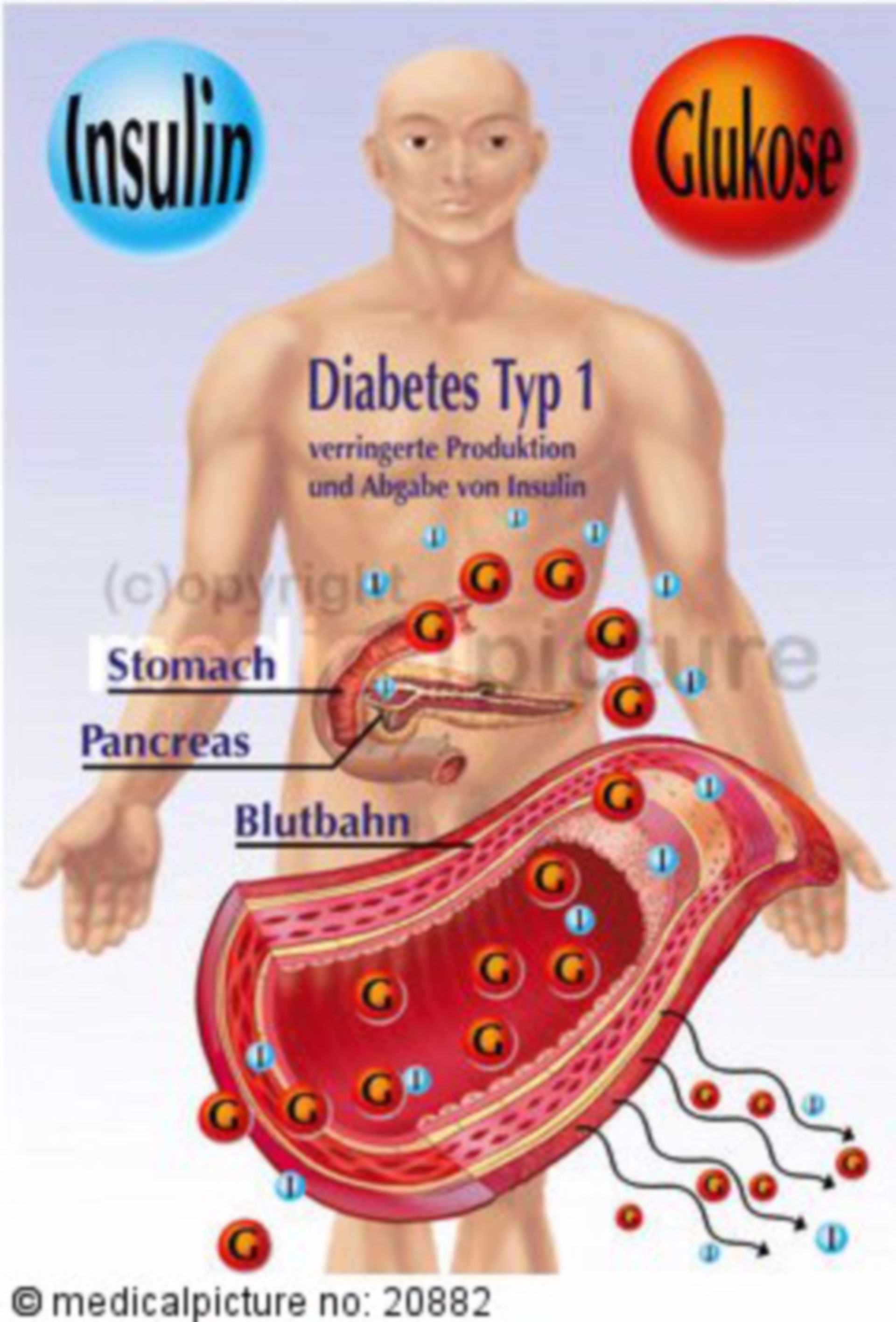 Insulinsekretion bei Menschen mit Typ-1-Diabetes