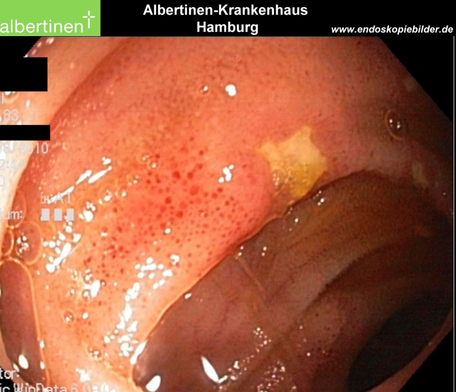 Crohn's disease (Endoscopy)