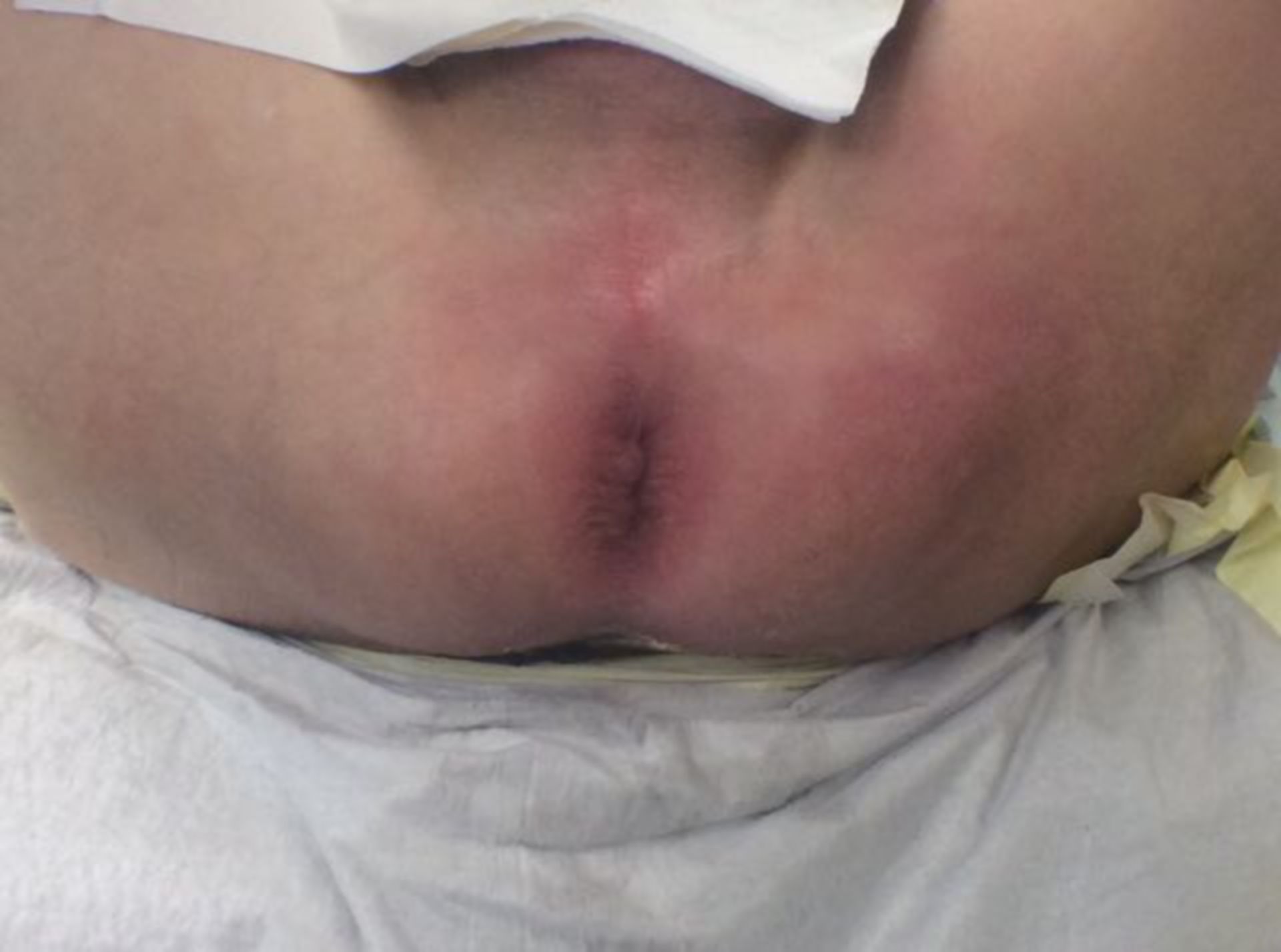 Fournier gangrene- not a classical anorectal abscess