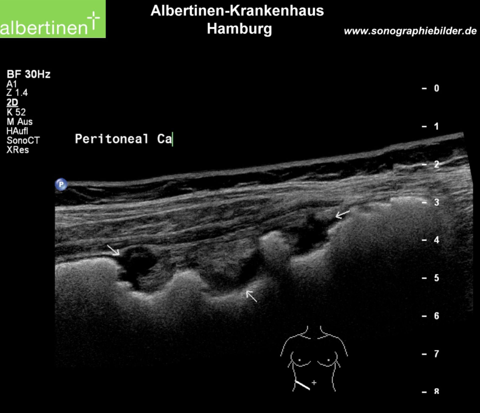 Peritoneal-Carcinose Sono Pfeile