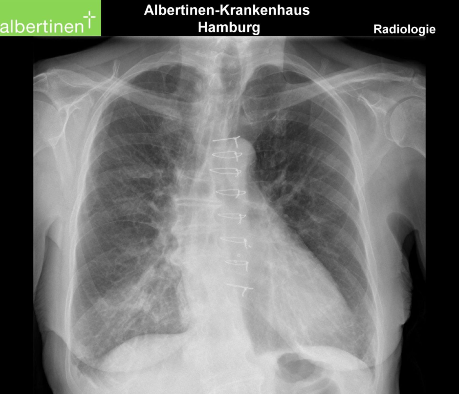 Rö-Thorax Aspirationspneumonie p.a.