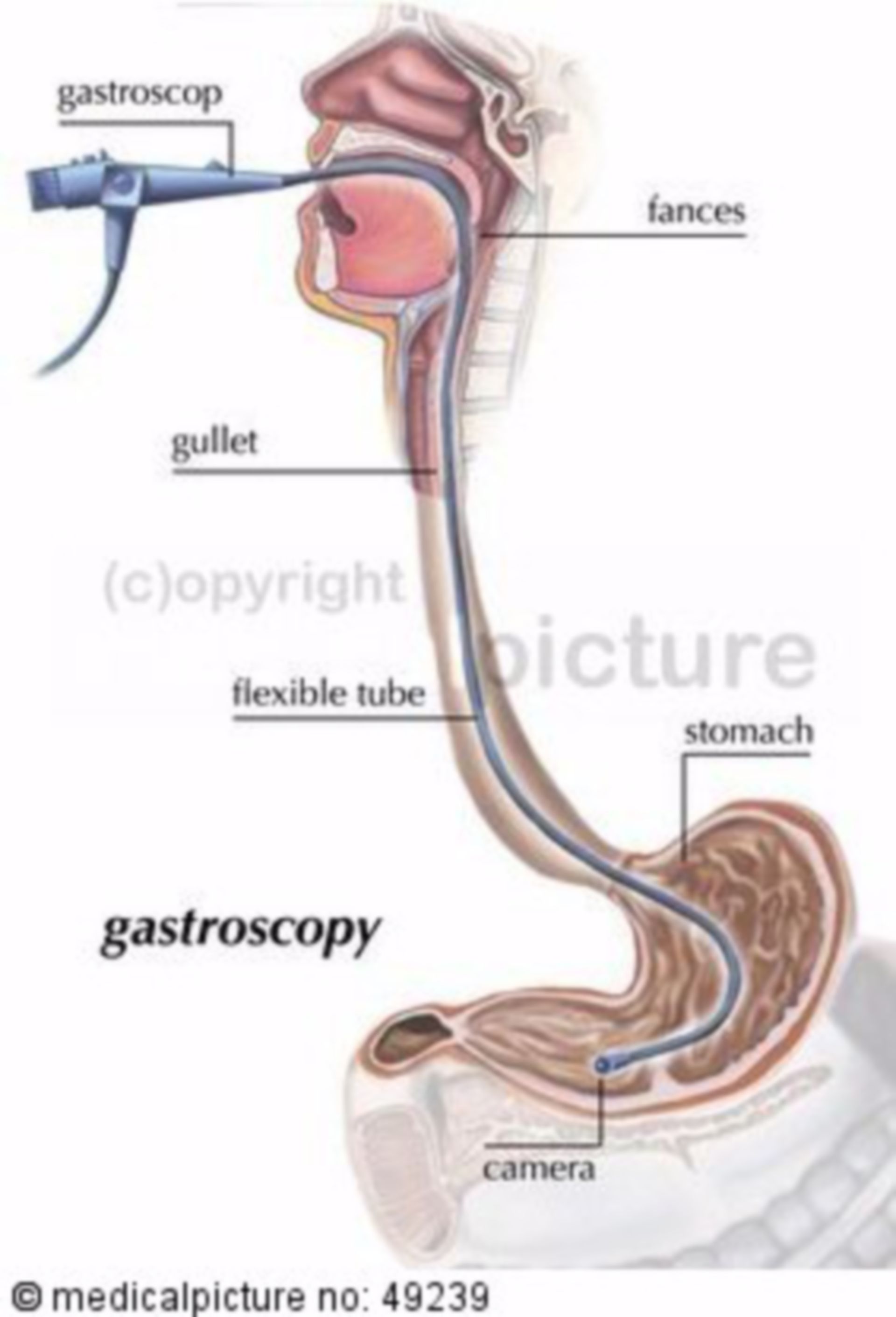  Magenspiegelung (Gastroskopie) 
