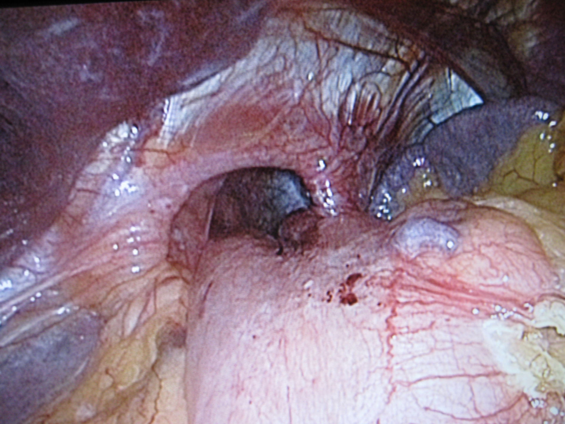 Paraesophageal hiatal hernia