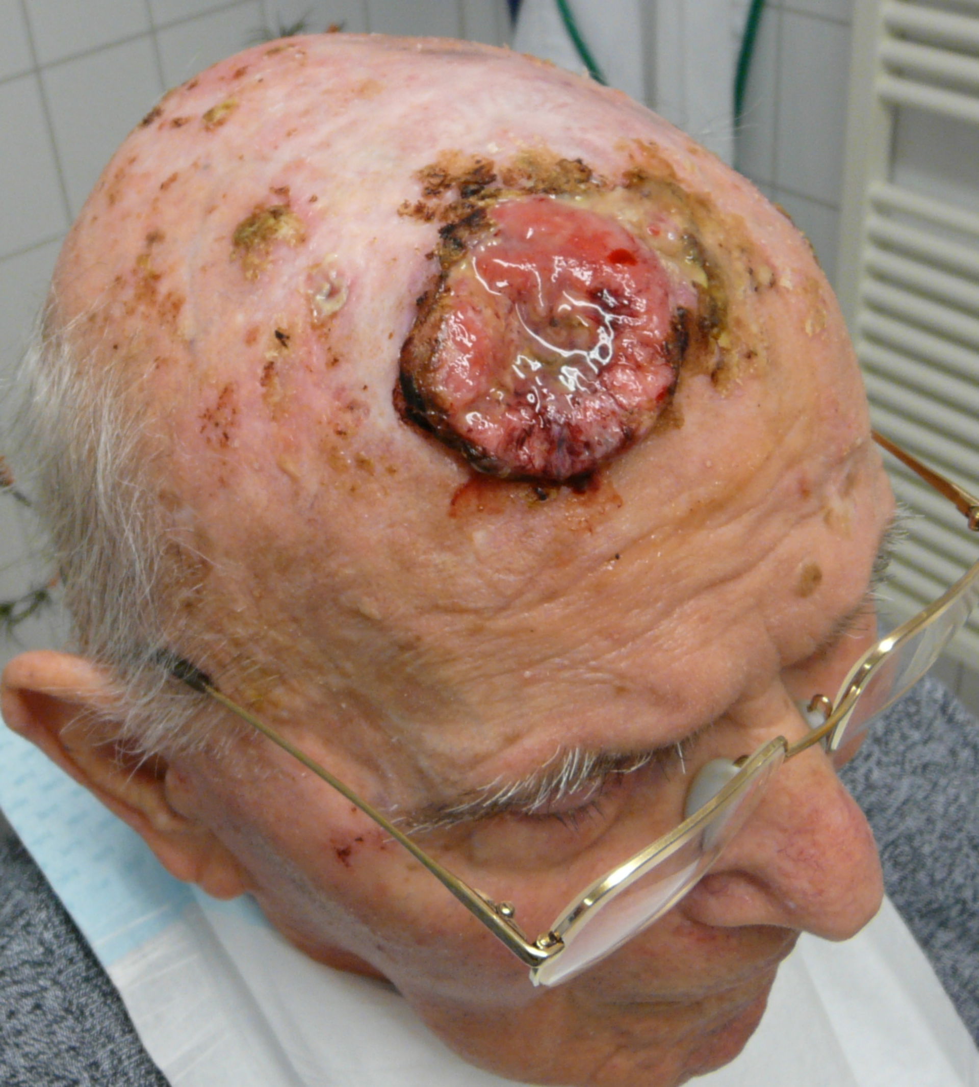 Squamous cell carcinoma