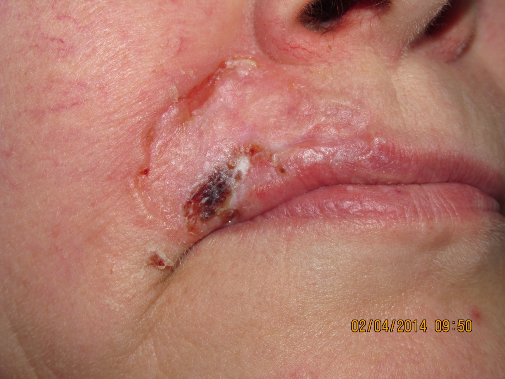 Tumore della pelle posizionato sul labbro superiore
