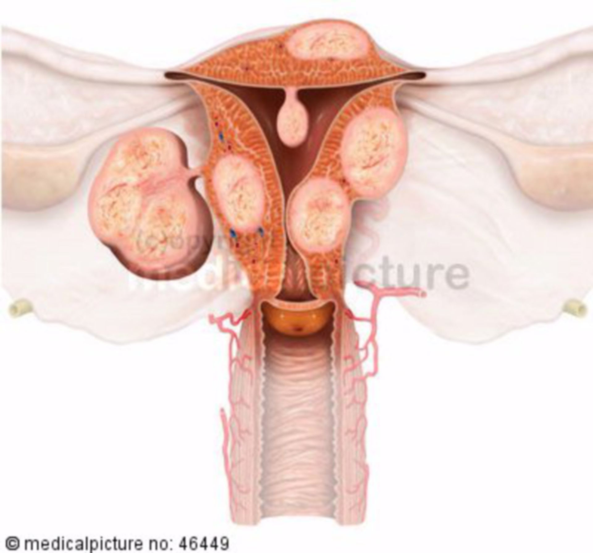 Leiomyoma of the uterus