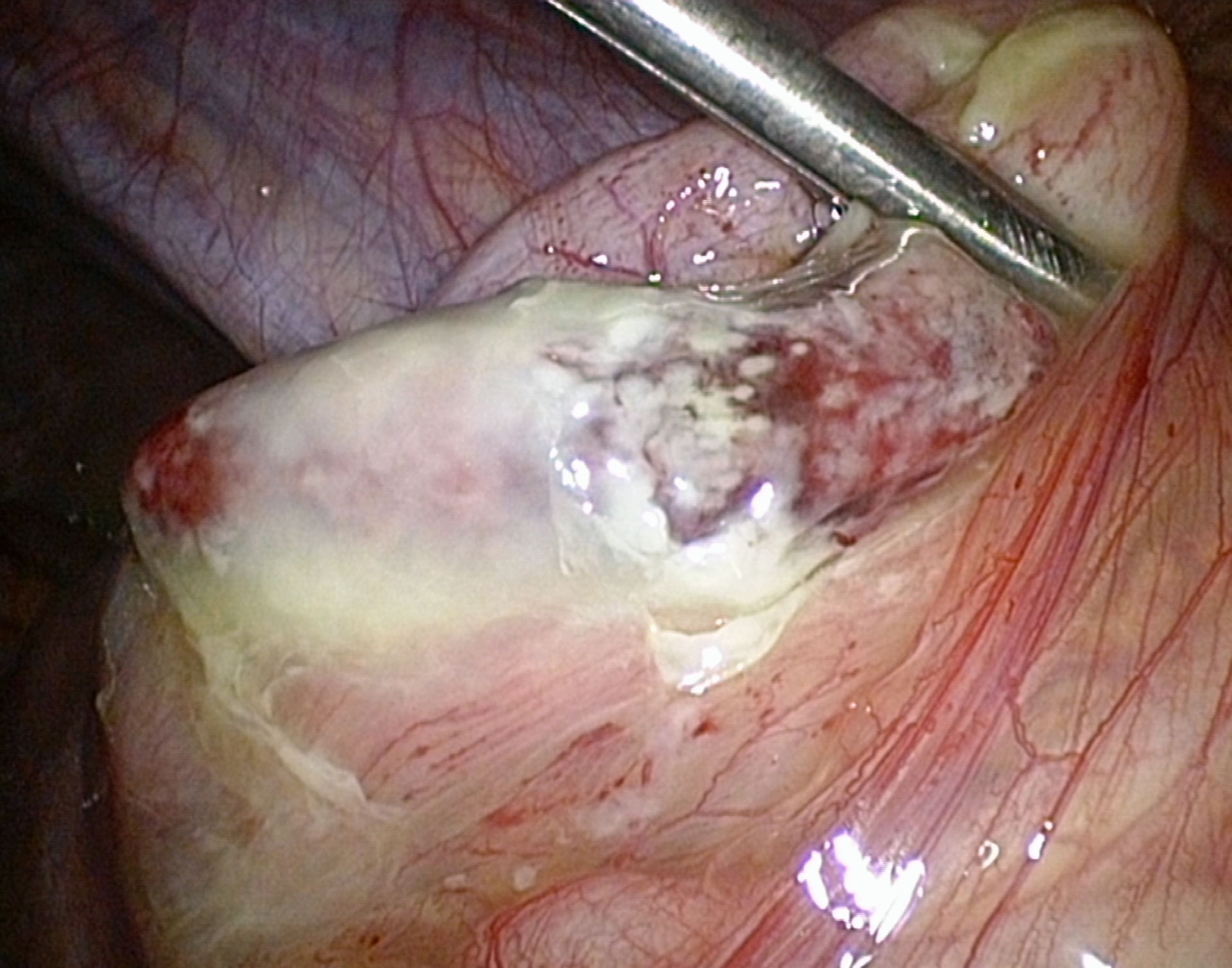 Appendizitis perforata - Laparoskopie (3)