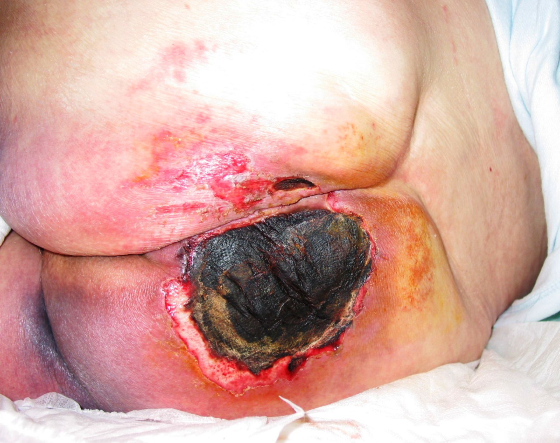 Úlcera por decúbito