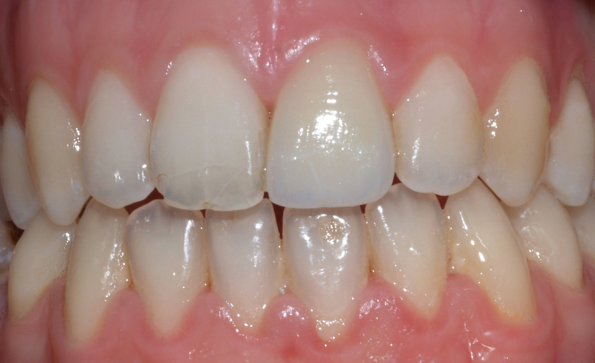 Whitened teeth - After