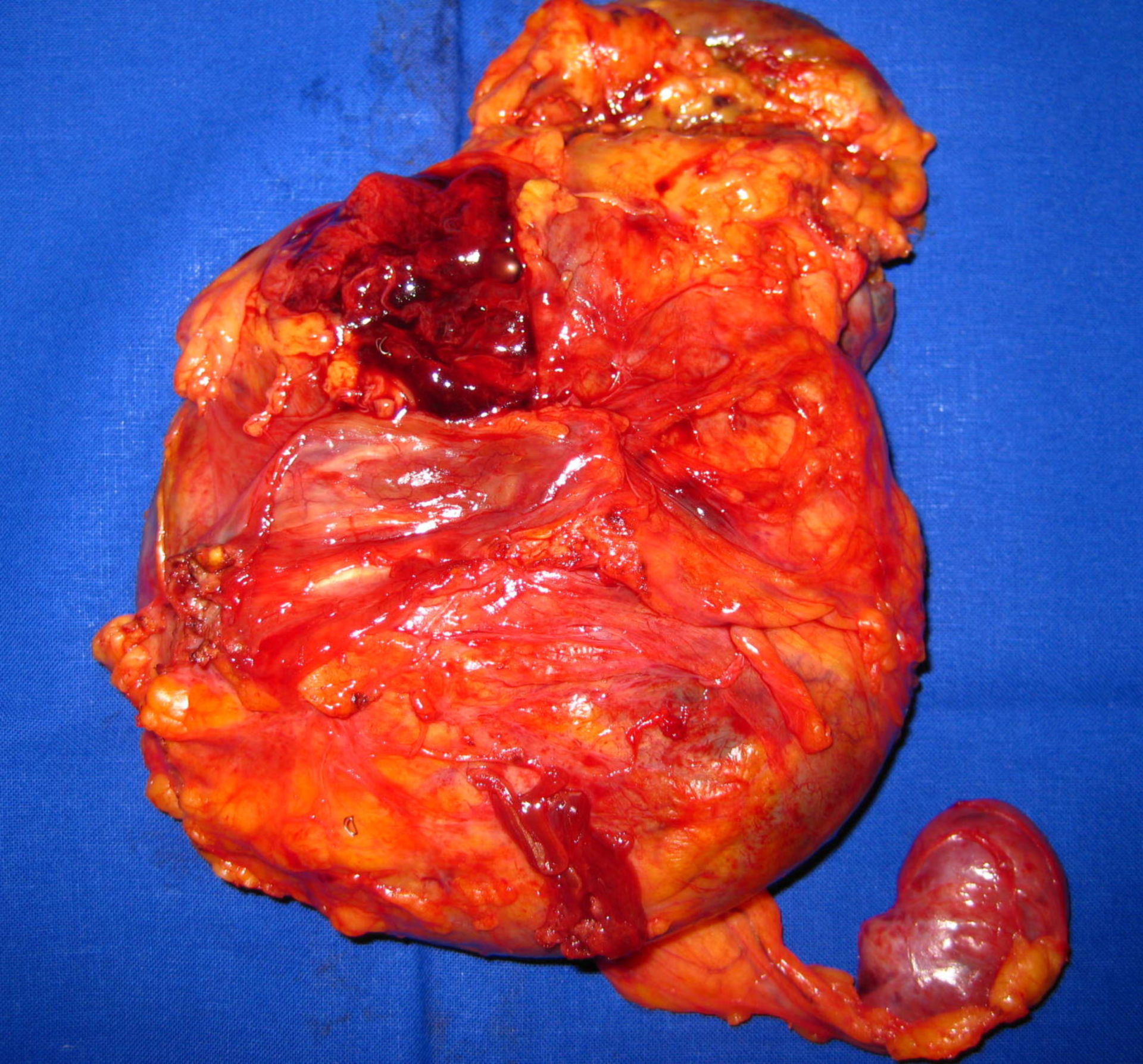 Reccurent leiomyosarcoma